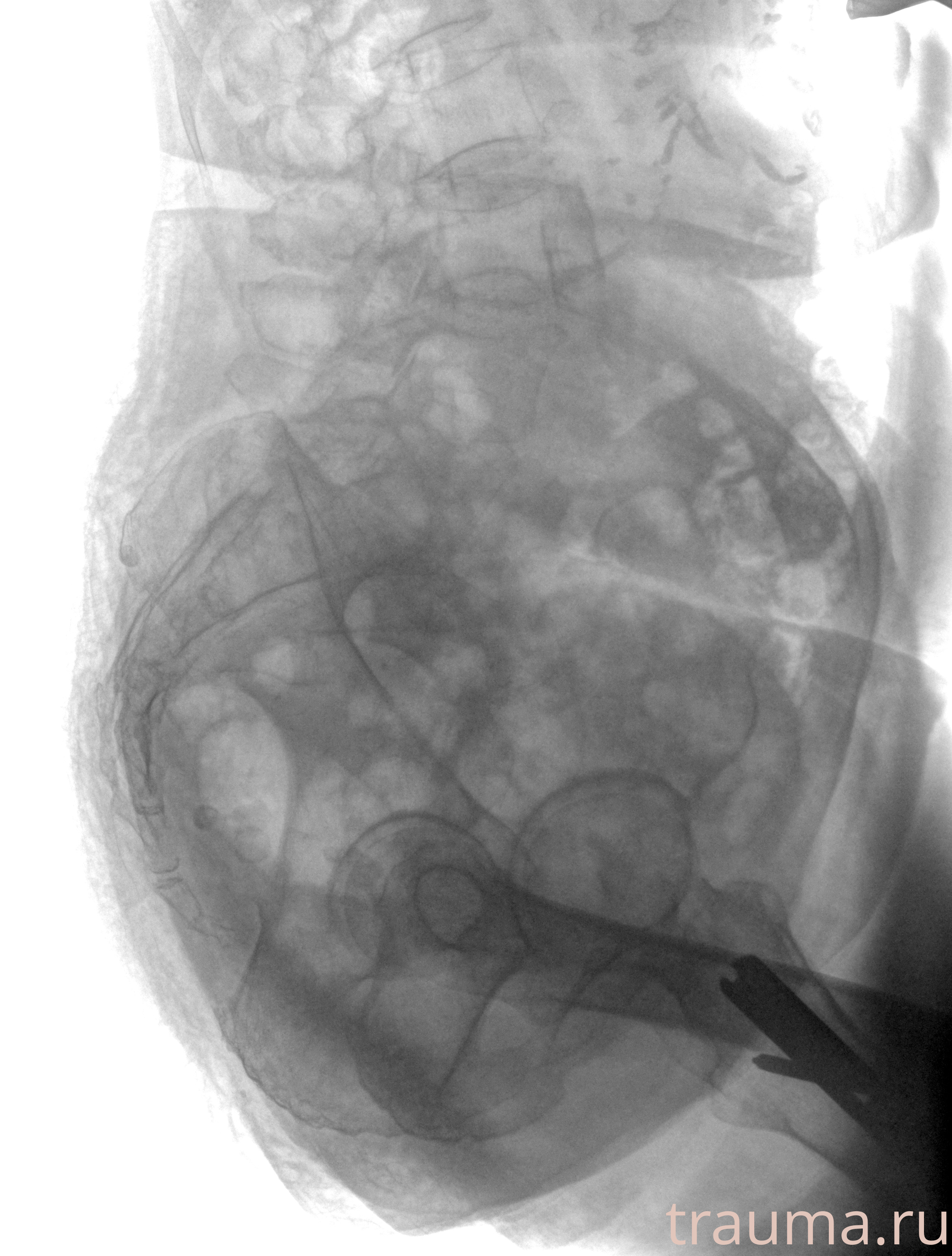 Рентген на дому: по вашему адресу приезжает врач-рентгенолог, травматолог-ортопед с мобильным рентгеновским аппаратом, проводит диагностику травмы или заболевания, делает необходимые рентгенограммы, дает рекомендации по дальнейшему лечению. Получить качественные снимки в домашних условиях возможно благодаря уникальной методике, разработанной МосРентген Центром для института  Склифосовского