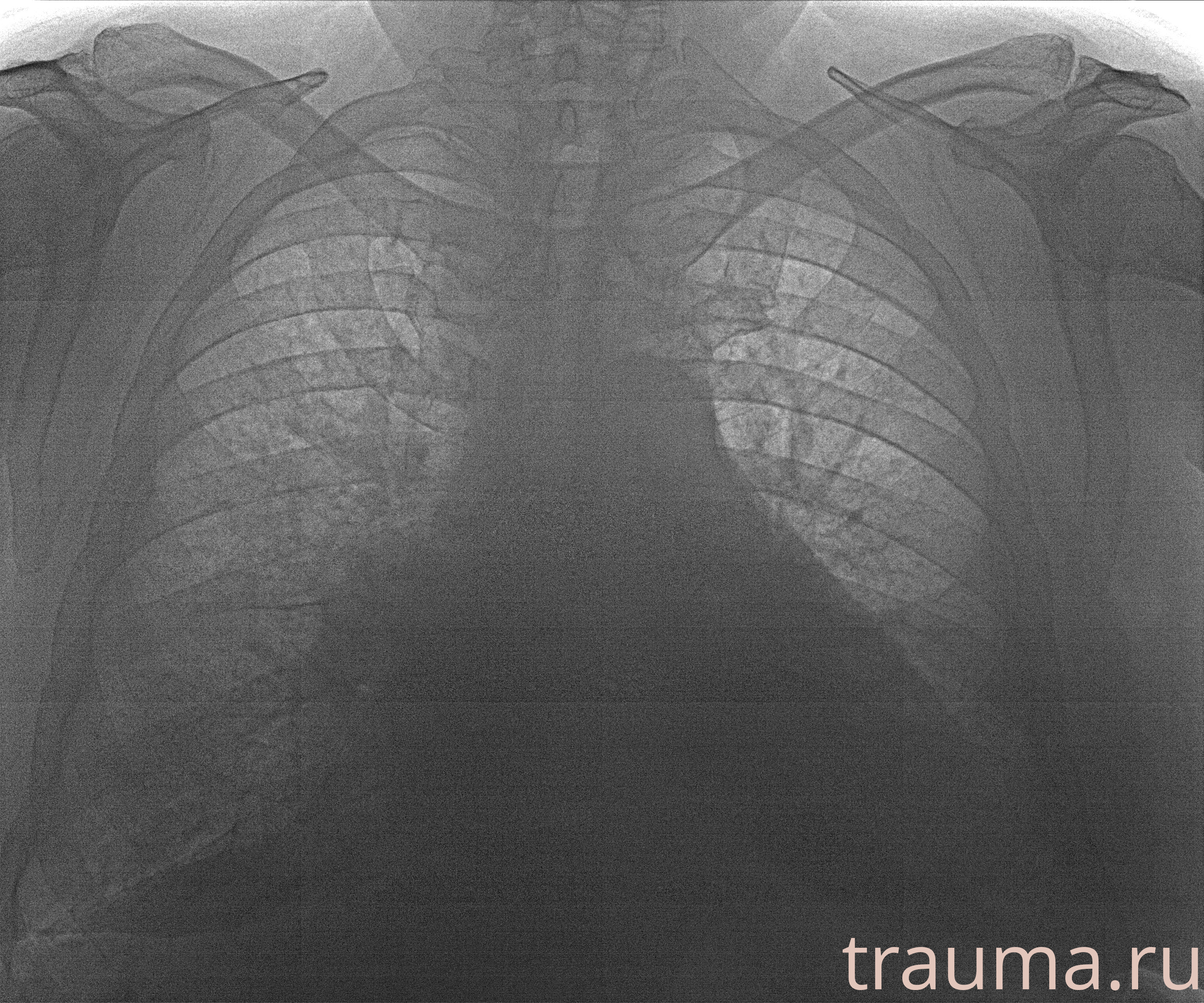 Рентген на дому: по вашему адресу приезжает врач-рентгенолог, травматолог-ортопед с мобильным рентгеновским аппаратом, проводит диагностику травмы или заболевания, делает необходимые рентгенограммы, дает рекомендации по дальнейшему лечению. Получить качественные снимки в домашних условиях возможно благодаря уникальной методике, разработанной МосРентген Центром для института  Склифосовского
