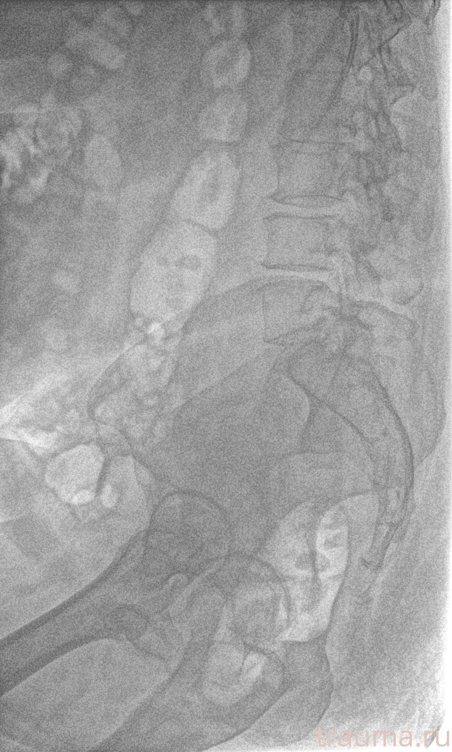 Рентген на дому: по вашему адресу приезжает врач-рентгенолог, травматолог-ортопед с мобильным рентгеновским аппаратом, проводит диагностику травмы или заболевания, делает необходимые рентгенограммы, дает рекомендации по дальнейшему лечению. Получить качественные снимки в домашних условиях возможно благодаря уникальной методике, разработанной МосРентген Центром для института  Склифосовского