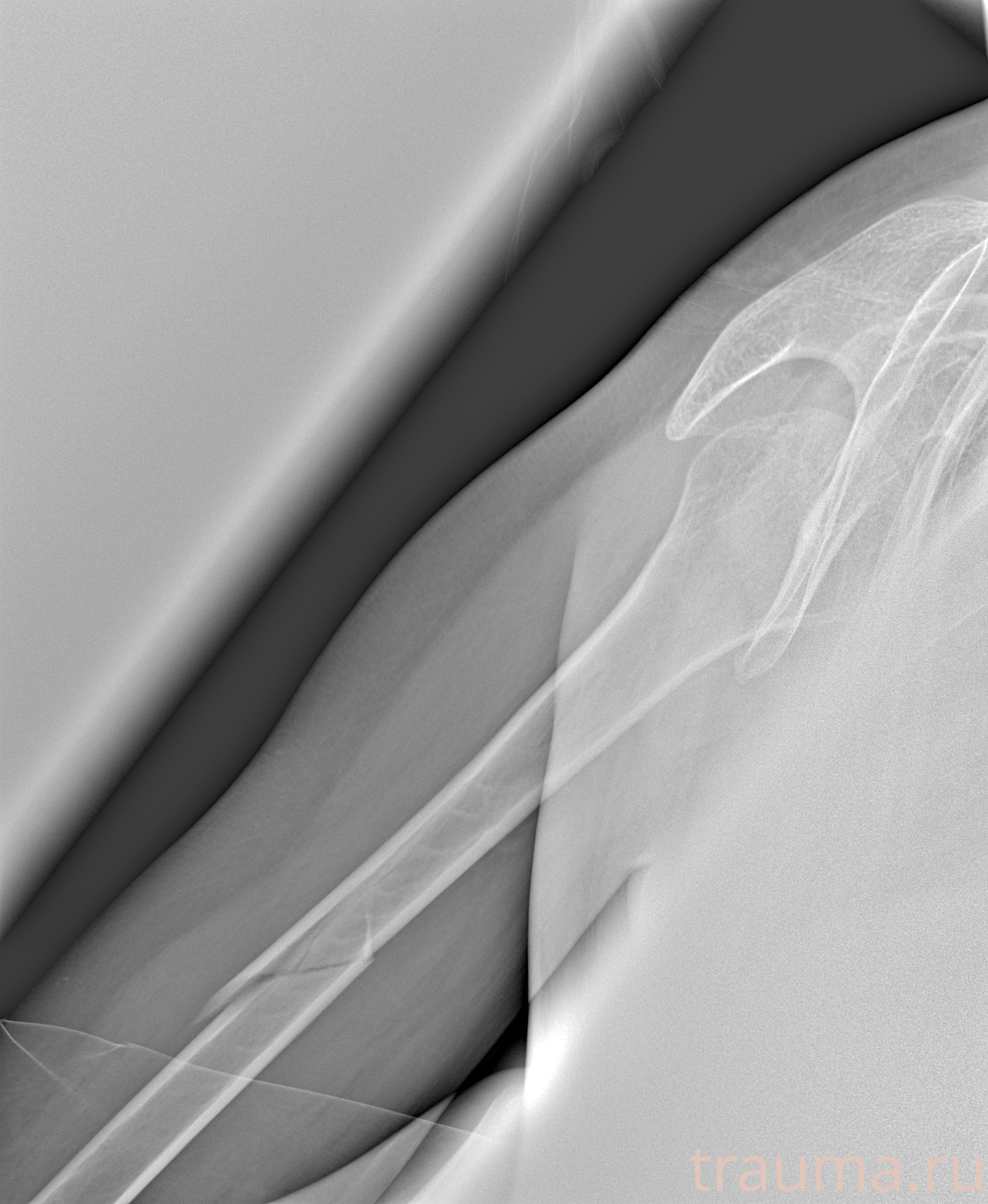 Рентген на дому: по вашему адресу приезжает врач-рентгенолог, травматолог-ортопед с мобильным рентгеновским аппаратом, проводит диагностику травмы или заболевания, делает необходимые рентгенограммы, дает рекомендации по дальнейшему лечению. Получить качественные снимки в домашних условиях возможно благодаря уникальной методике, разработанной МосРентген Центром для института  Склифосовского