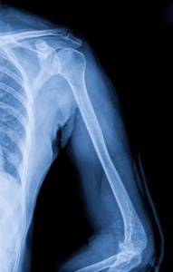 Костно-пластический вариант лечения многоскольчатых переломов плечевой кости(частный случай)