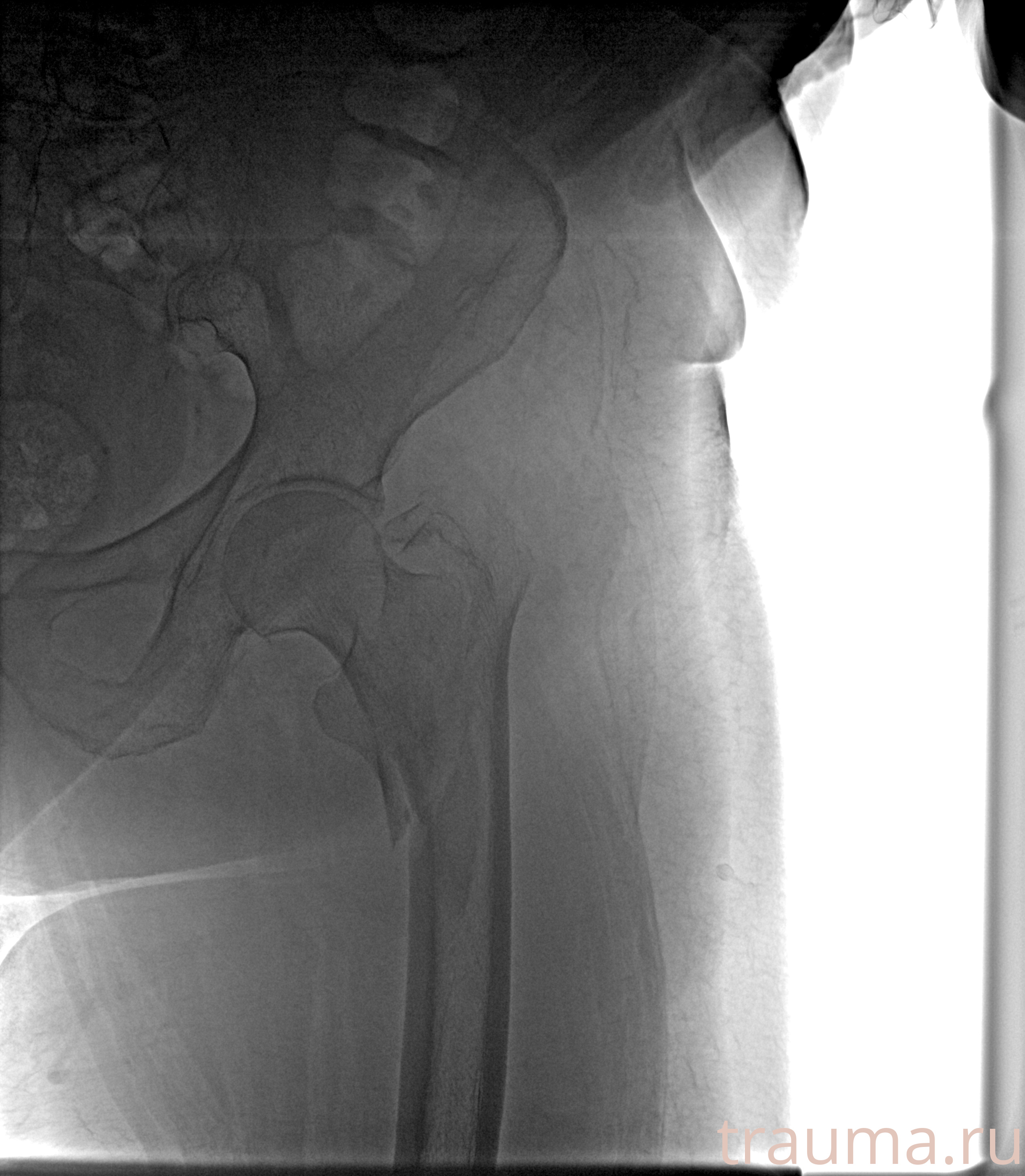 Рентген на дому: по вашему адресу приезжает врач-рентгенолог, травматолог-ортопед с мобильным рентгеновским аппаратом, проводит диагностику травмы или заболевания, делает необходимые рентгенограммы, дает рекомендации по дальнейшему лечению. Получить качественные снимки в домашних условиях возможно благодаря уникальной методике, разработанной МосРентген Центром для института  Склифосовского