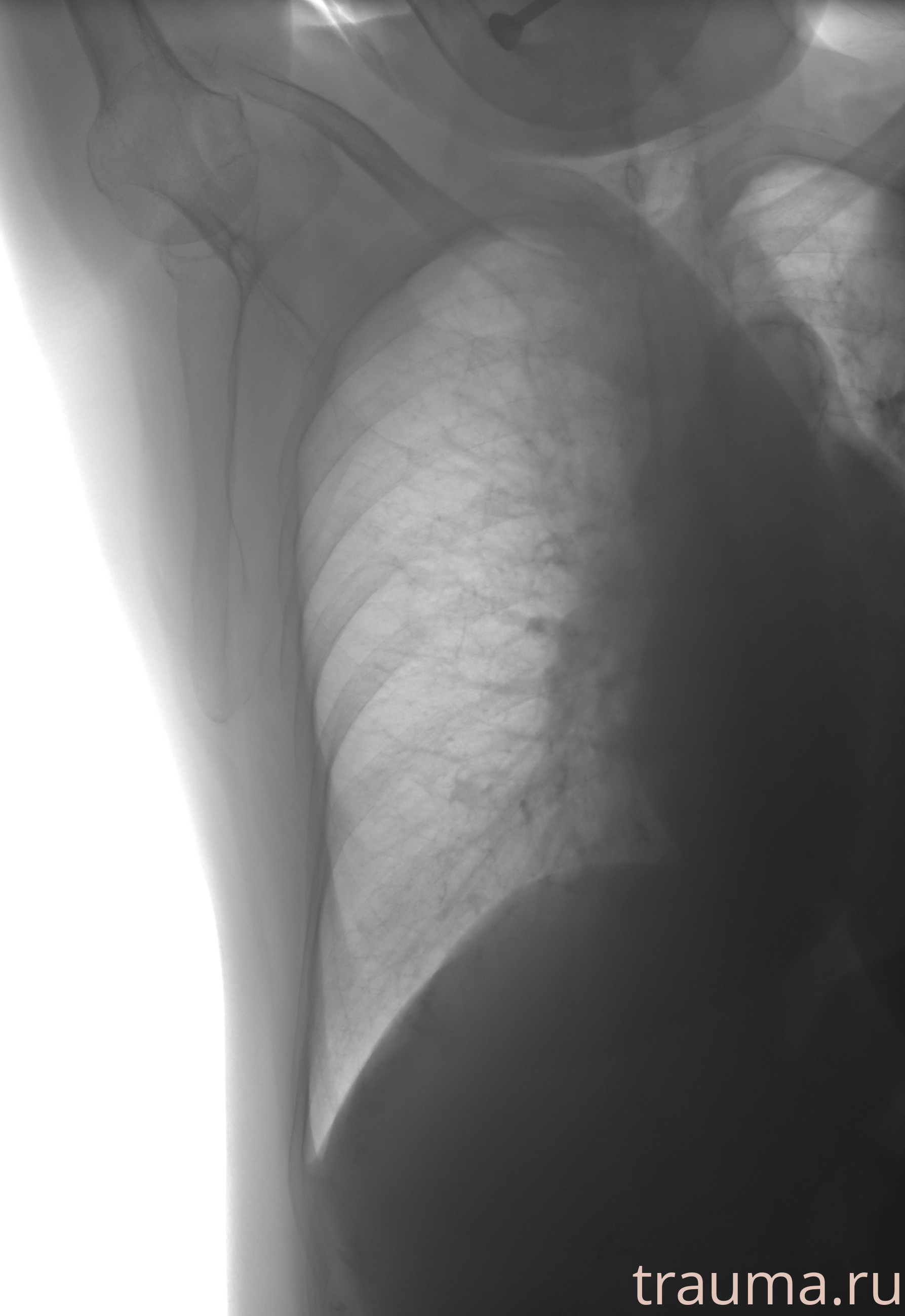 Рентген на дому: по вашему адресу приезжает врач-рентгенолог, травматолог-ортопед с мобильным рентгеновским аппаратом, проводит диагностику травмы или заболевания, делает необходимые рентгенограммы, дает рекомендации по дальнейшему лечению. Получить качественные снимки в домашних условиях возможно благодаря уникальной методике, разработанной МосРентген Центром для института  Склифосовского