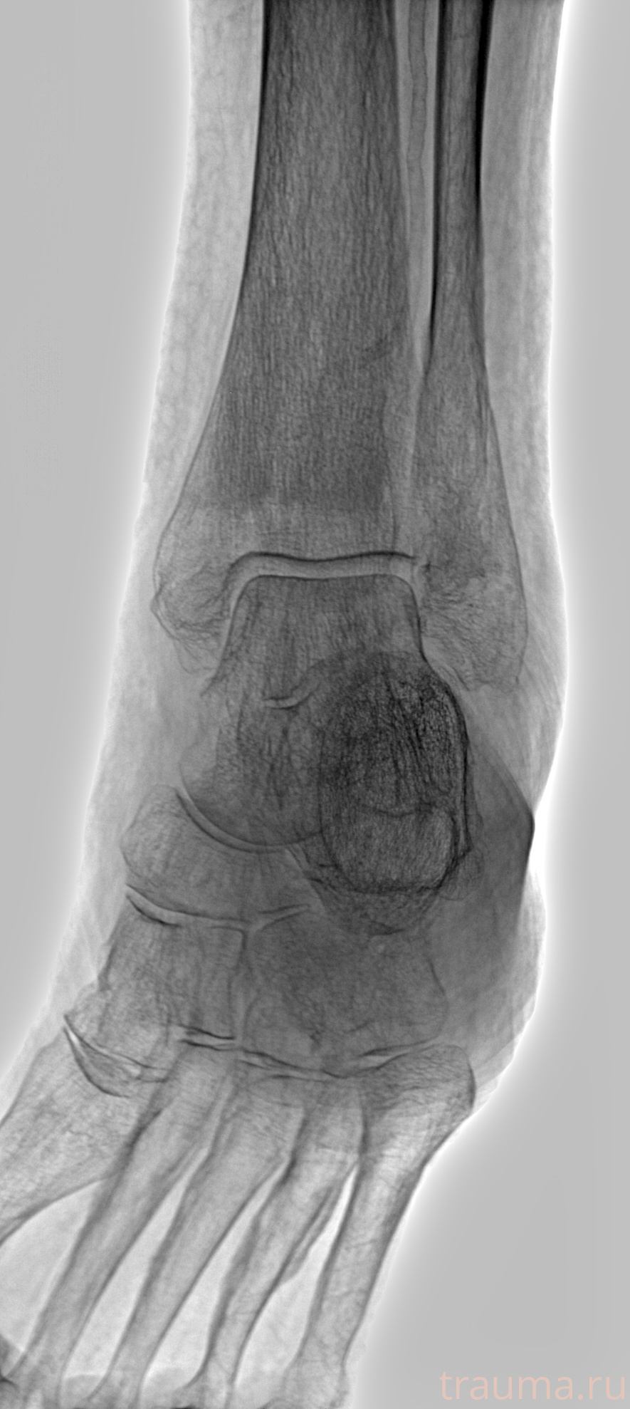 Рентген на дому: по вашему адресу приезжает врач-рентгенолог, травматолог-ортопед с мобильным рентгеновским аппаратом, проводит диагностику травмы или заболевания, делает необходимые рентгенограммы, дает рекомендации по дальнейшему лечению. Получить качественные снимки в домашних условиях возможно благодаря уникальной методике, разработанной МосРентген Центром для института  Склифосовского