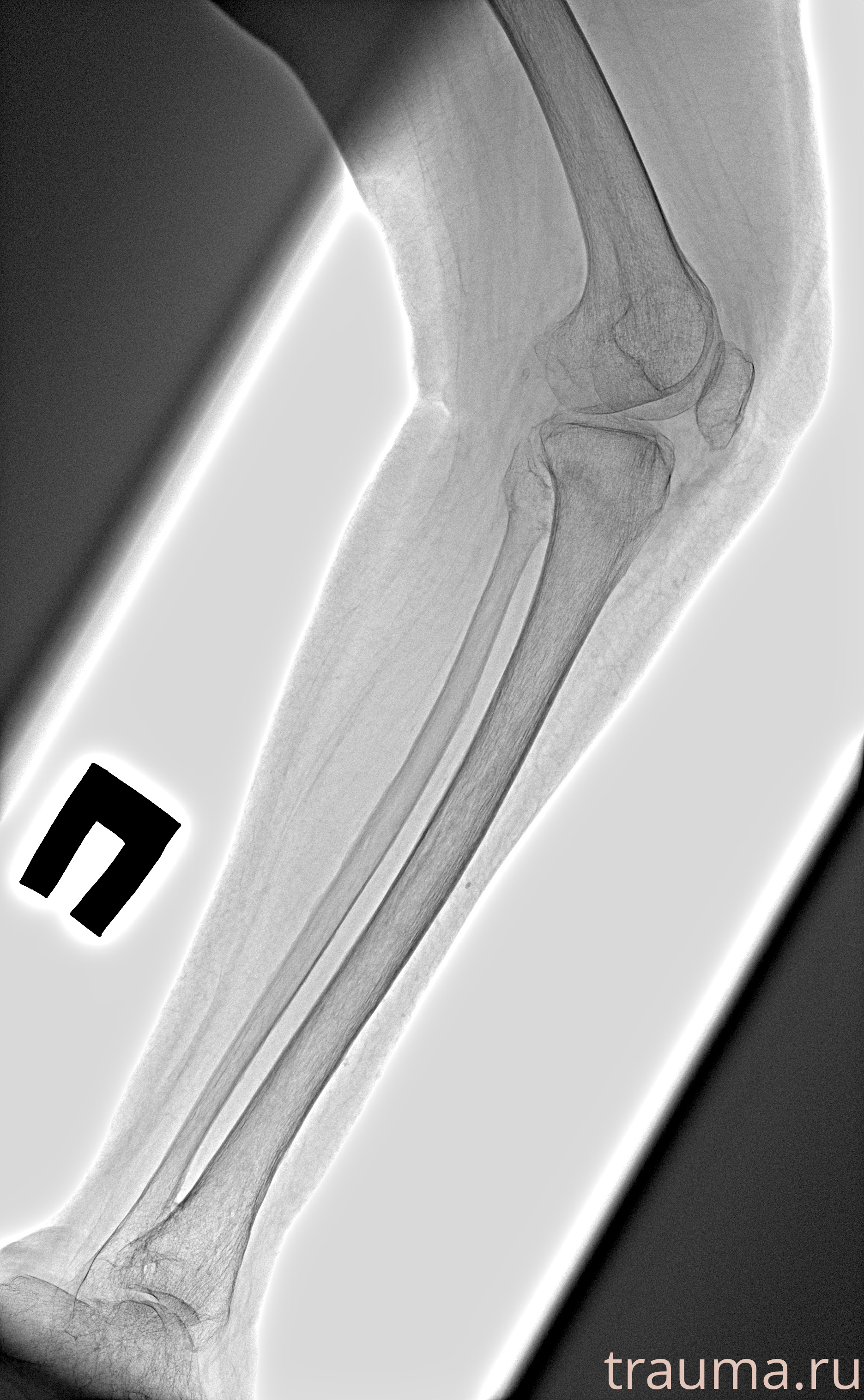 Рентген на дому: по вашему адресу приезжает врач-рентгенолог, травматолог-ортопед с мобильным рентгеновским аппаратом, проводит диагностику травмы или заболевания, делает необходимые рентгенограммы, дает рекомендации по дальнейшему лечению. Получить качественные снимки в домашних условиях возможно благодаря уникальной методике, разработанной МосРентген Центром для института  Склифосовского