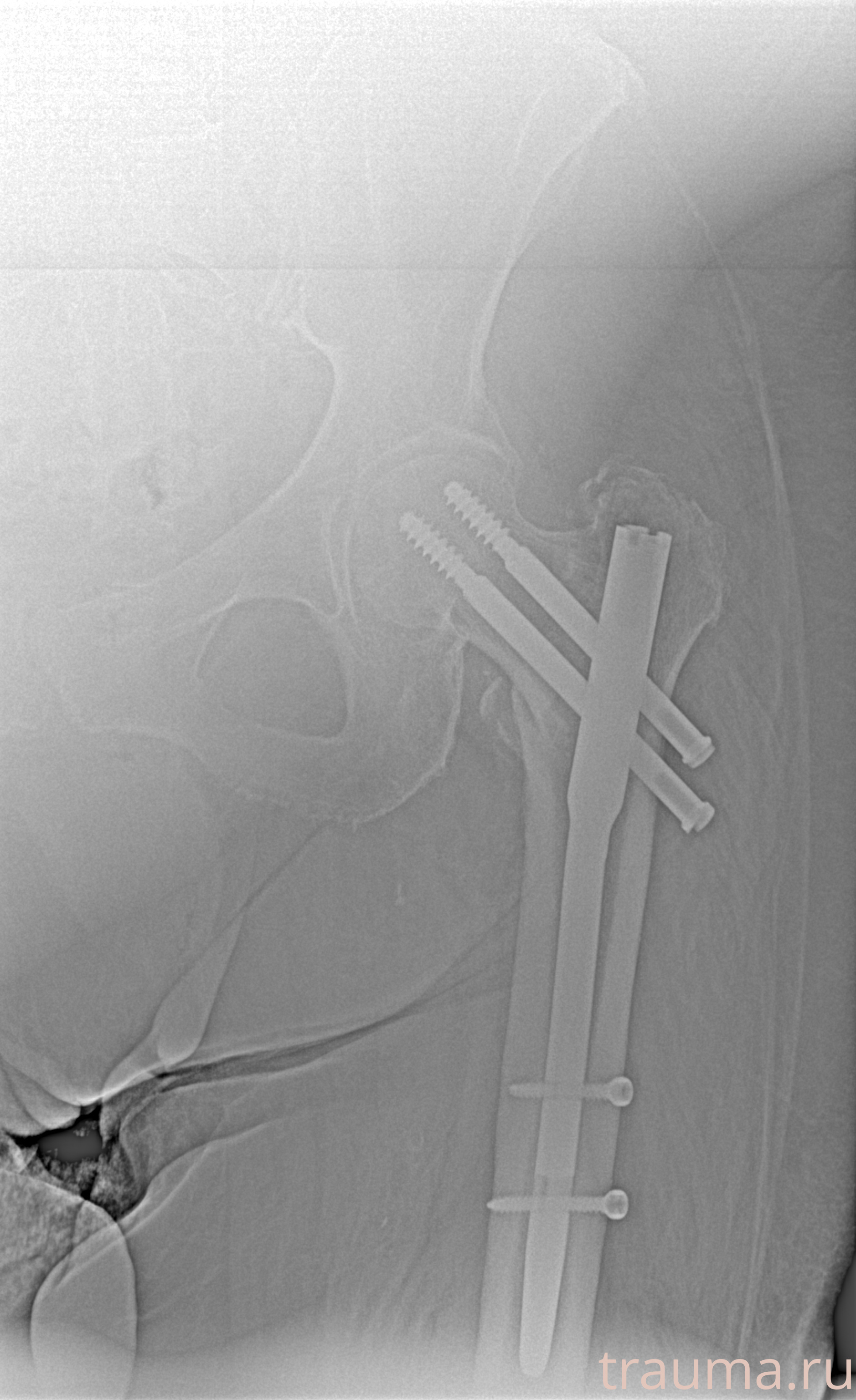 Рентген на дому: по вашему адресу приезжает врач-рентгенолог, травматолог-ортопед с мобильным рентгеновским аппаратом, проводит диагностику травмы или заболевания, делает необходимые рентгенограммы, дает рекомендации по дальнейшему лечению. Получить качественные снимки в домашних условиях возможно благодаря уникальной методике, разработанной МосРентген Центром для института  Склифосовского