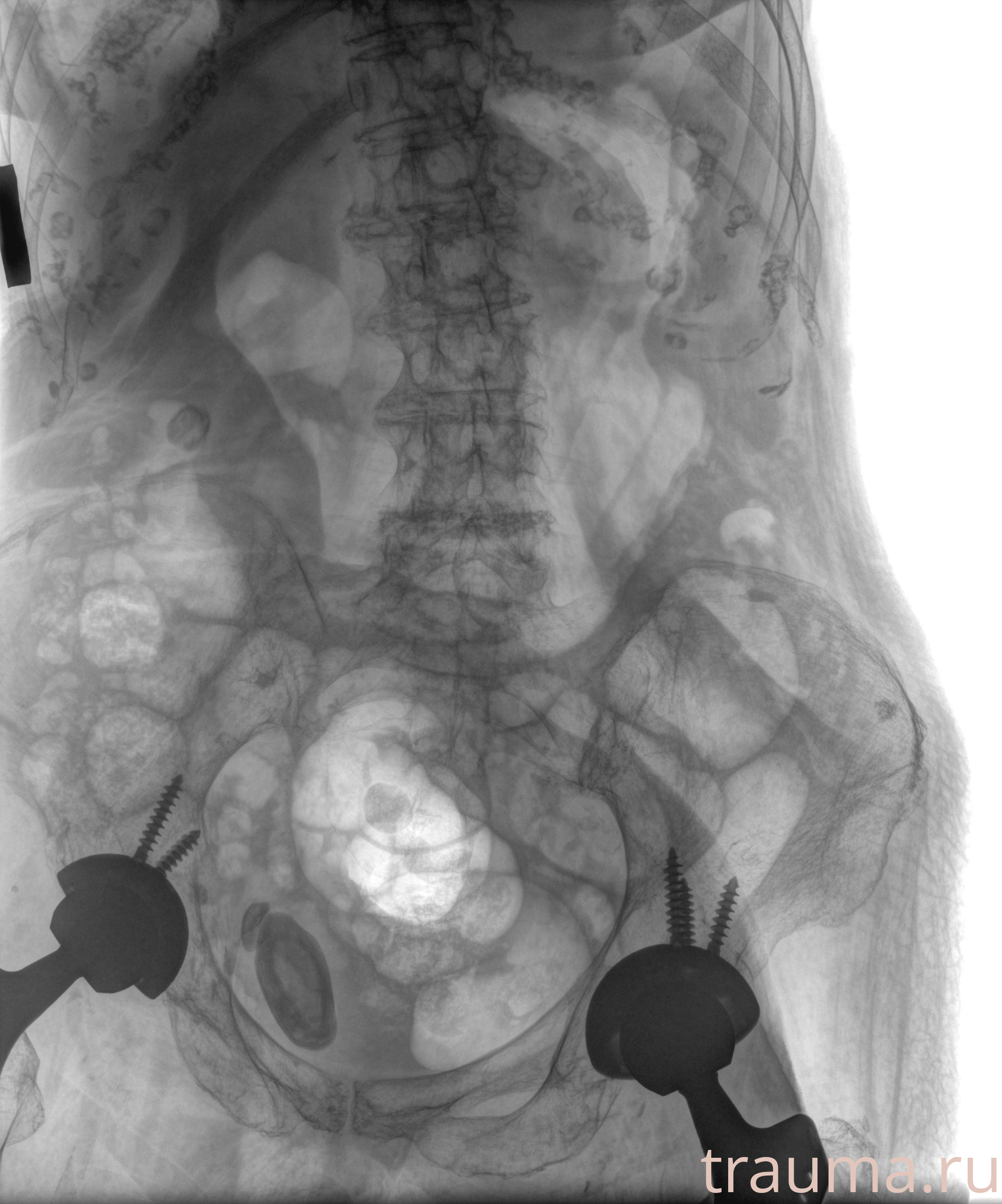 Рентген на дому: по вашему адресу приезжает врач-рентгенолог, травматолог-ортопед с мобильным рентгеновским аппаратом, проводит диагностику травмы или заболевания, делает необходимые рентгенограммы, дает рекомендации по дальнейшему лечению. Получить качественные снимки в домашних условиях возможно благодаря уникальной методике, разработанной МосРентген Центром для института  Склифосовского