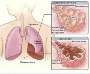 Дифференциальная рентгенодиагностика заболеваний органов дыхания и средостения(Часть 2)