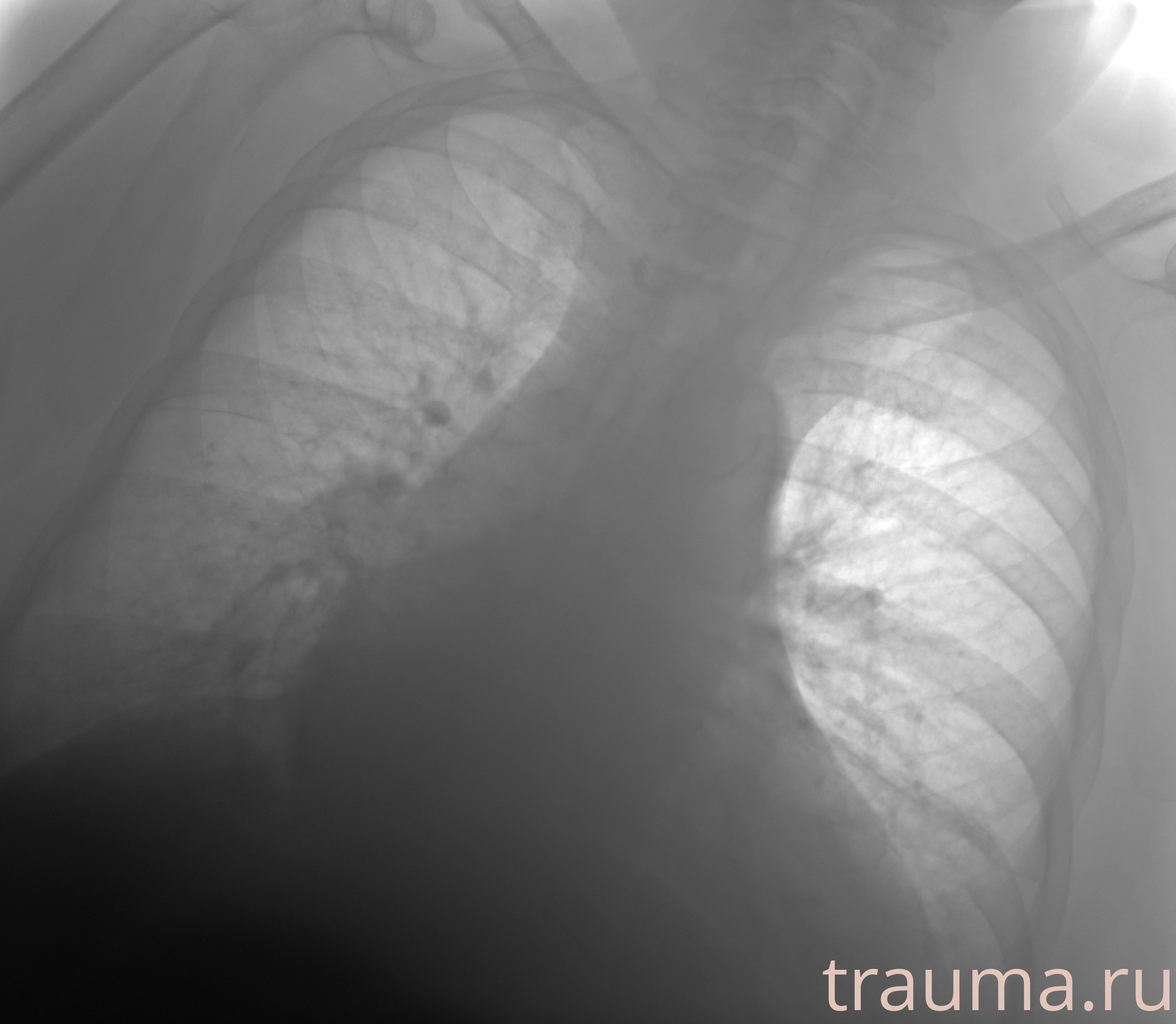 Рентген на дому: по вашему адресу приезжает врач-рентгенолог, травматолог-ортопед с мобильным рентгеновским аппаратом, проводит диагностику травмы или заболевания, делает необходимые рентгенограммы, дает рекомендации по дальнейшему лечению. Получить качественные снимки в домашних условиях возможно благодаря уникальной методике, разработанной МосРентген Центром для института  Склифосовского