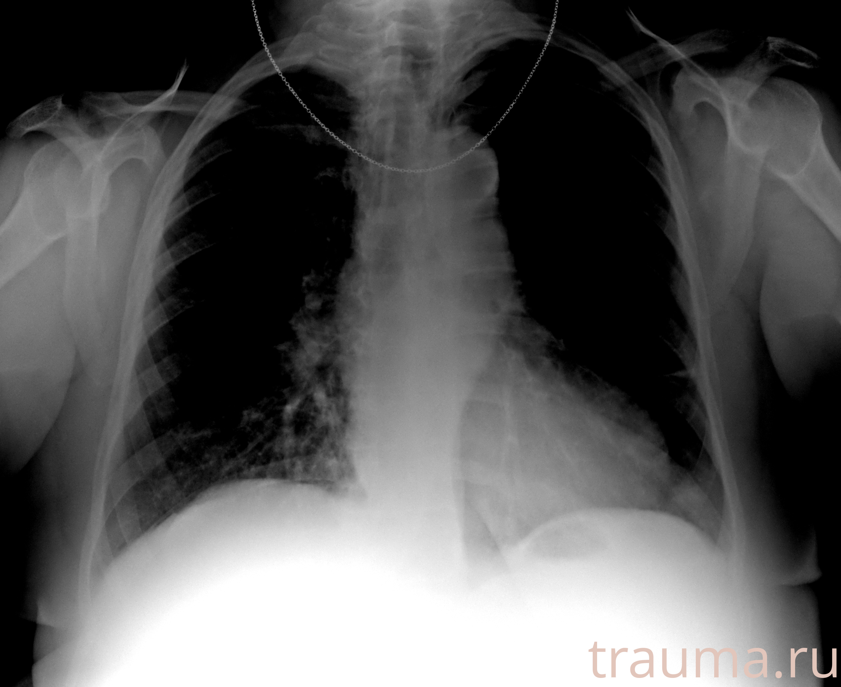 Рентген на дому: по вашему адресу приезжает врач-рентгенолог, травматолог-ортопед с мобильным рентгеновским аппаратом, проводит диагностику травмы или заболевания, делает необходимые рентгенограммы, дает рекомендации по дальнейшему лечению. Получить качественные снимки в домашних условиях возможно благодаря уникальной методике, разработанной МосРентген Центром для института  Склифосовского