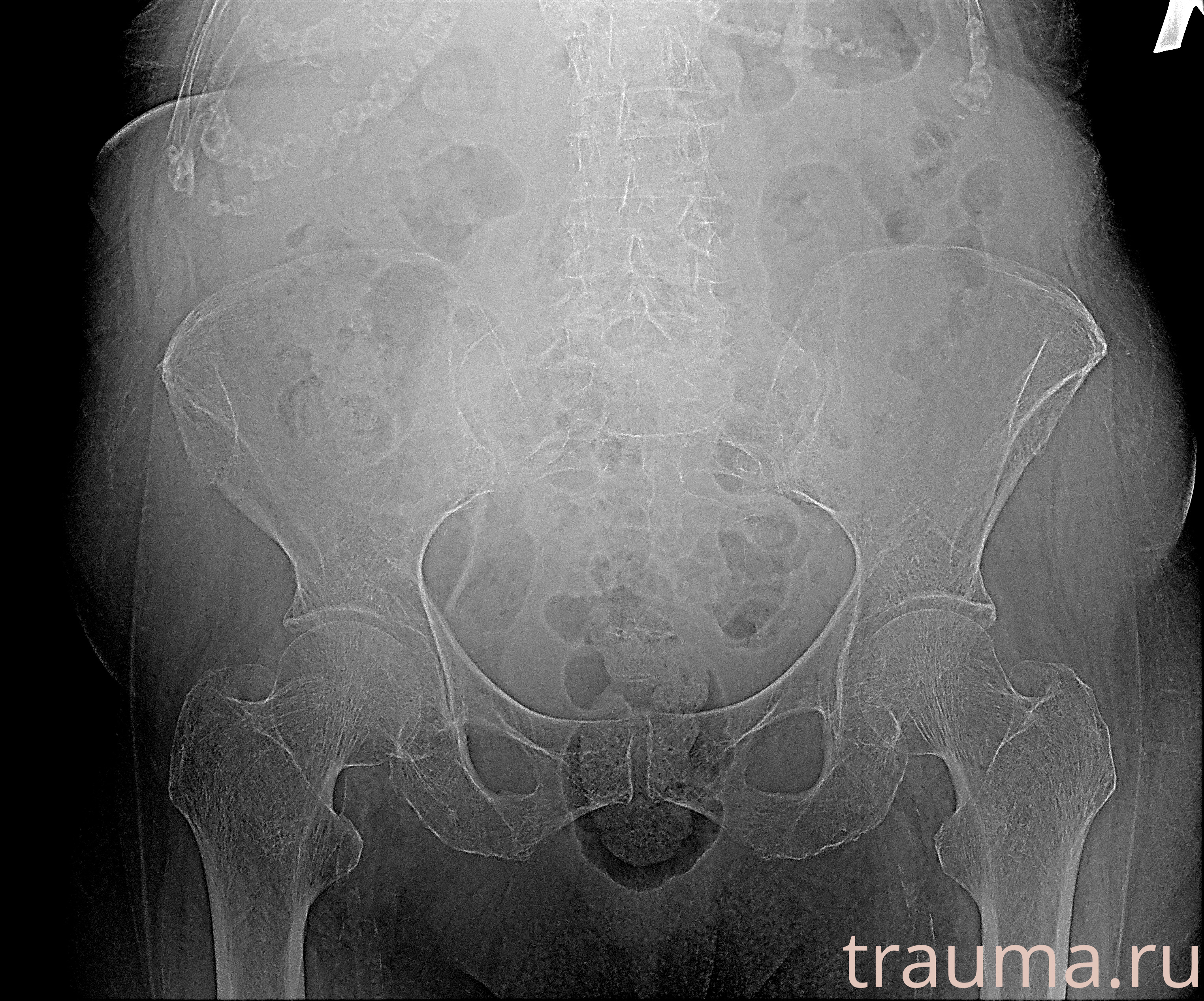 Рентген на дому: по вашему адресу приезжает врач-рентгенолог, травматолог-ортопед с мобильным рентгеновским аппаратом, проводит диагностику травмы или заболевания, делает необходимые рентгенограммы, дает рекомендации по дальнейшему лечению. Получить качественные снимки в домашних условиях возможно благодаря уникальной методике, разработанной МосРентген Центром для института  Склифосовского