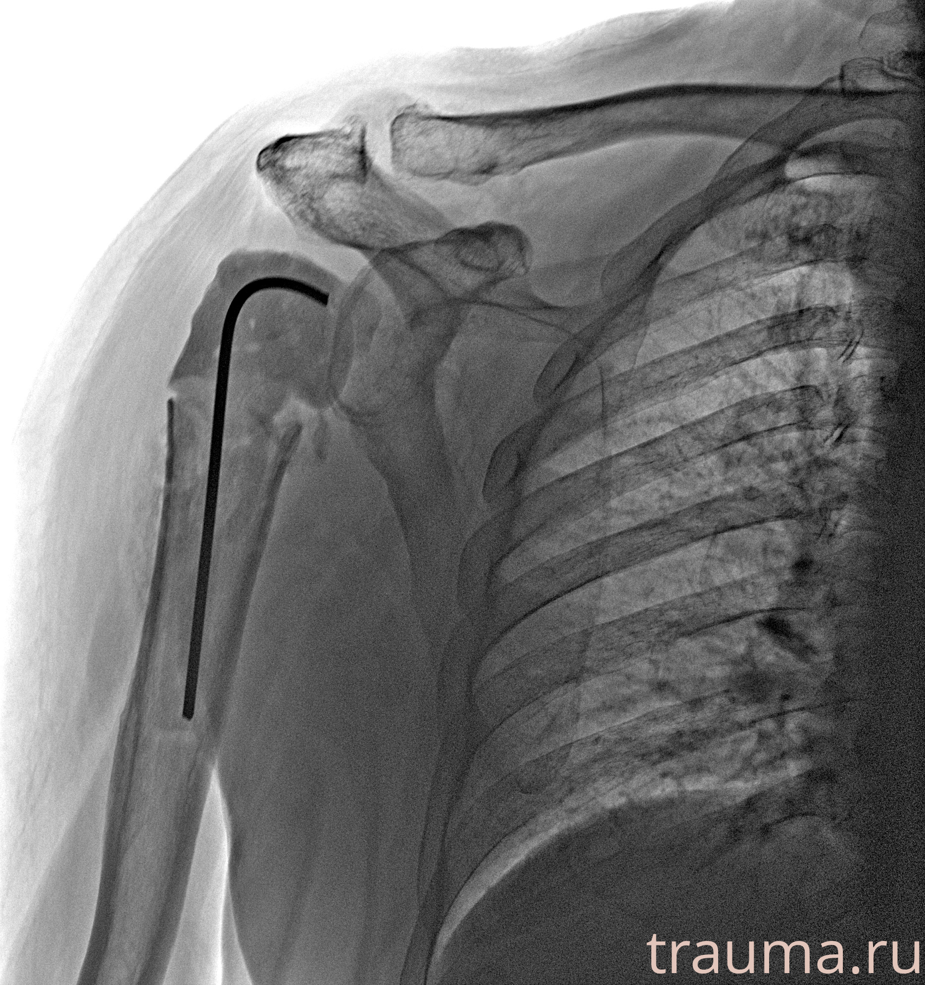 Рентген на дому: по вашему адресу приезжает врач-рентгенолог, травматолог-ортопед с мобильным рентгеновским аппаратом, проводит диагностику травмы или заболевания, делает необходимые рентгенограммы, дает рекомендации по дальнейшему лечению. Получить качественные снимки в домашних условиях возможно благодаря уникальной методике, разработанной МосРентген Центром для института  Склифосовского
