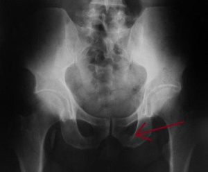 Лучевая диагностика переломов костей таза у детей Н-5 