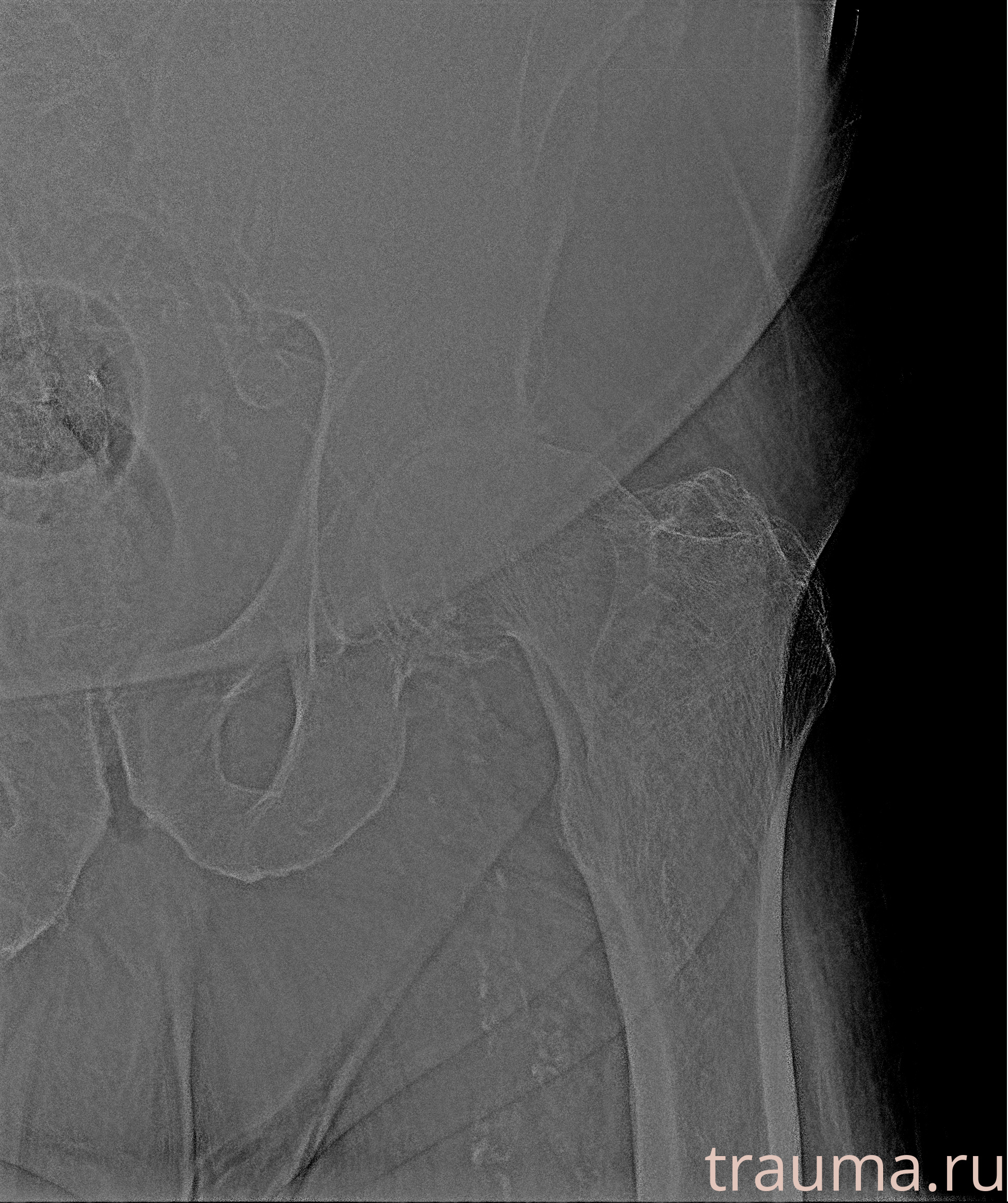 Рентген на дому: по вашему адресу приезжает врач-рентгенолог, травматолог-ортопед с мобильным рентгеновским аппаратом, проводит диагностику травмы или заболевания, делает необходимые рентгенограммы, дает рекомендации по дальнейшему лечению. Получить качественные снимки в домашних условиях возможно благодаря уникальной методике, разработанной МосРентген Центром для института  Склифосовского