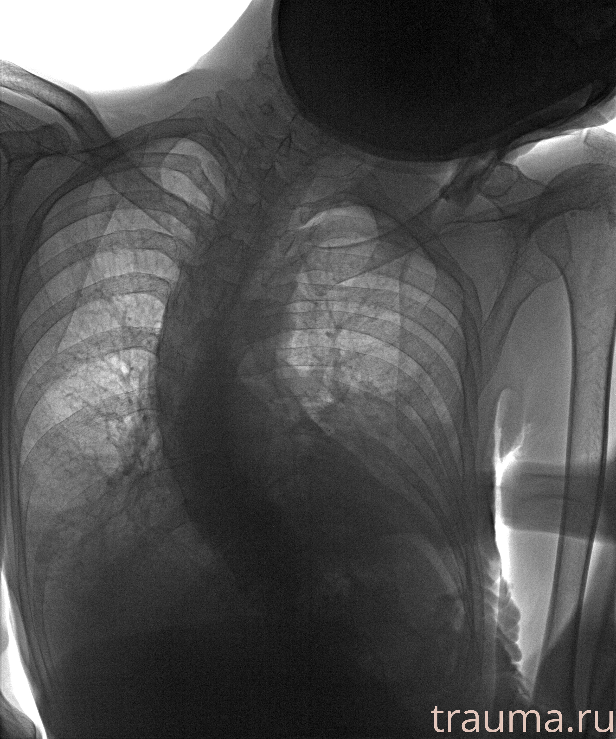 Рентген на дому: по вашему адресу приезжает врач-рентгенолог, травматолог-ортопед с мобильным рентгеновским аппаратом, проводит диагностику травмы или заболевания, делает необходимые рентгенограммы, дает рекомендации по дальнейшему лечению. Получить качественные снимки в домашних условиях возможно благодаря уникальной методике, разработанной МосРентген Центром для института  Склифосовского