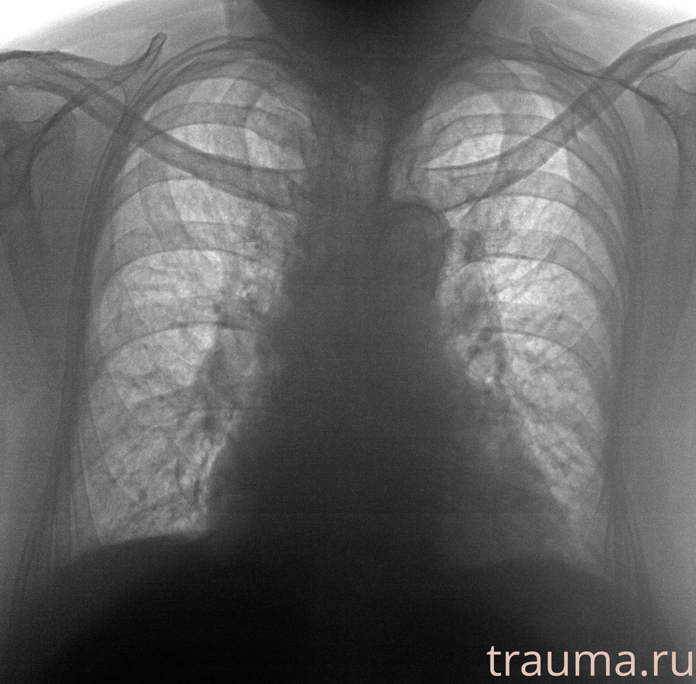 Рентген на дому: по вашему адресу приезжает врач-рентгенолог, травматолог-ортопед с мобильным рентгеновским аппаратом, проводит диагностику травмы или заболевания, делает необходимые рентгенограммы, дает рекомендации по дальнейшему лечению. Получить качественные снимки в домашних условиях возможно благодаря уникальной методике, разработанной МосРентген Центром для института  Склифосовского