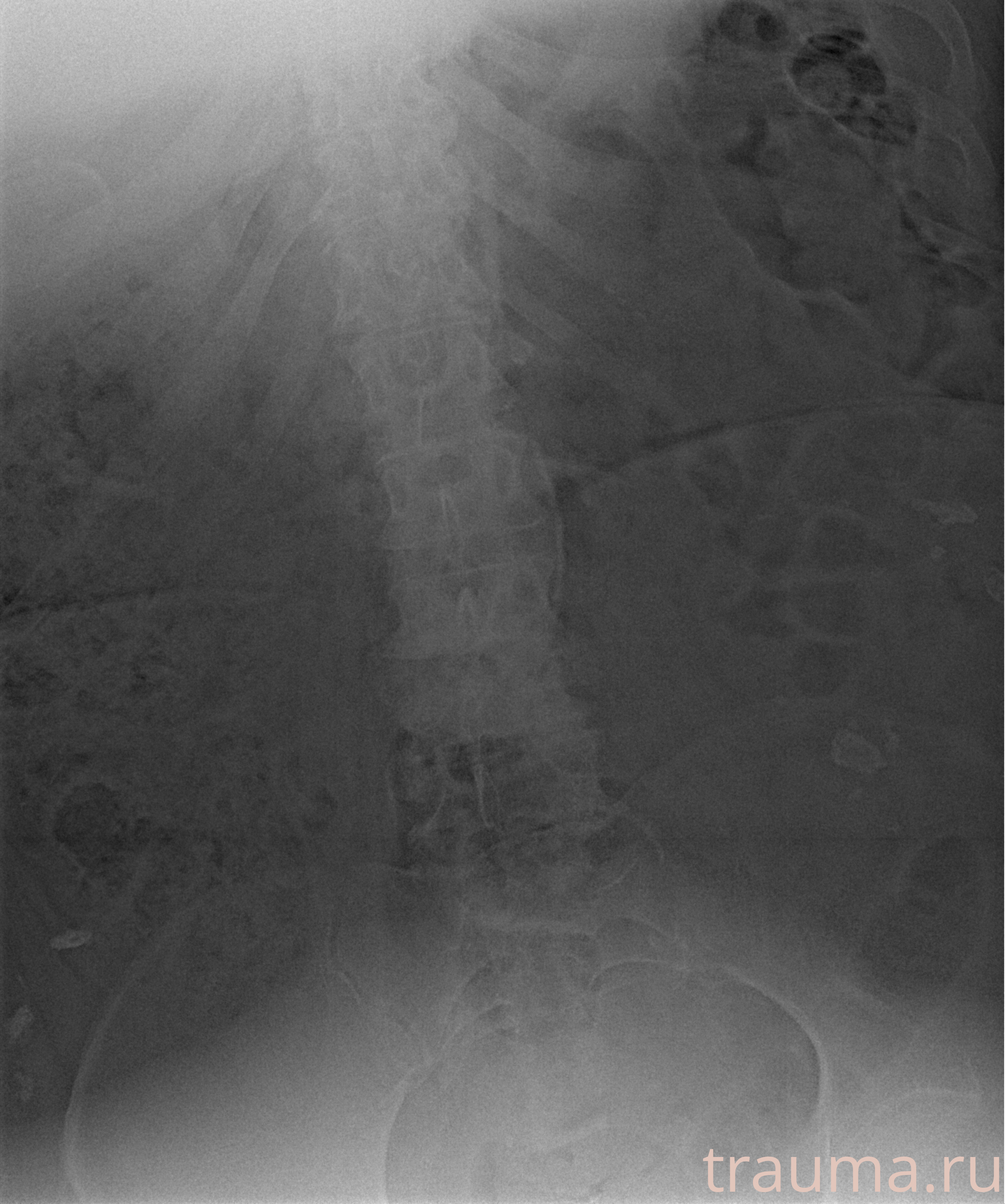 Рентген на дому: по вашему адресу приезжает врач-рентгенолог, травматолог-ортопед с мобильным рентгеновским аппаратом, проводит диагностику травмы или заболевания, делает необходимые рентгенограммы, дает рекомендации по дальнейшему лечению. Получить качественные снимки в домашних условиях возможно благодаря уникальной методике, разработанной МосРентген Центром для института  Склифосовского