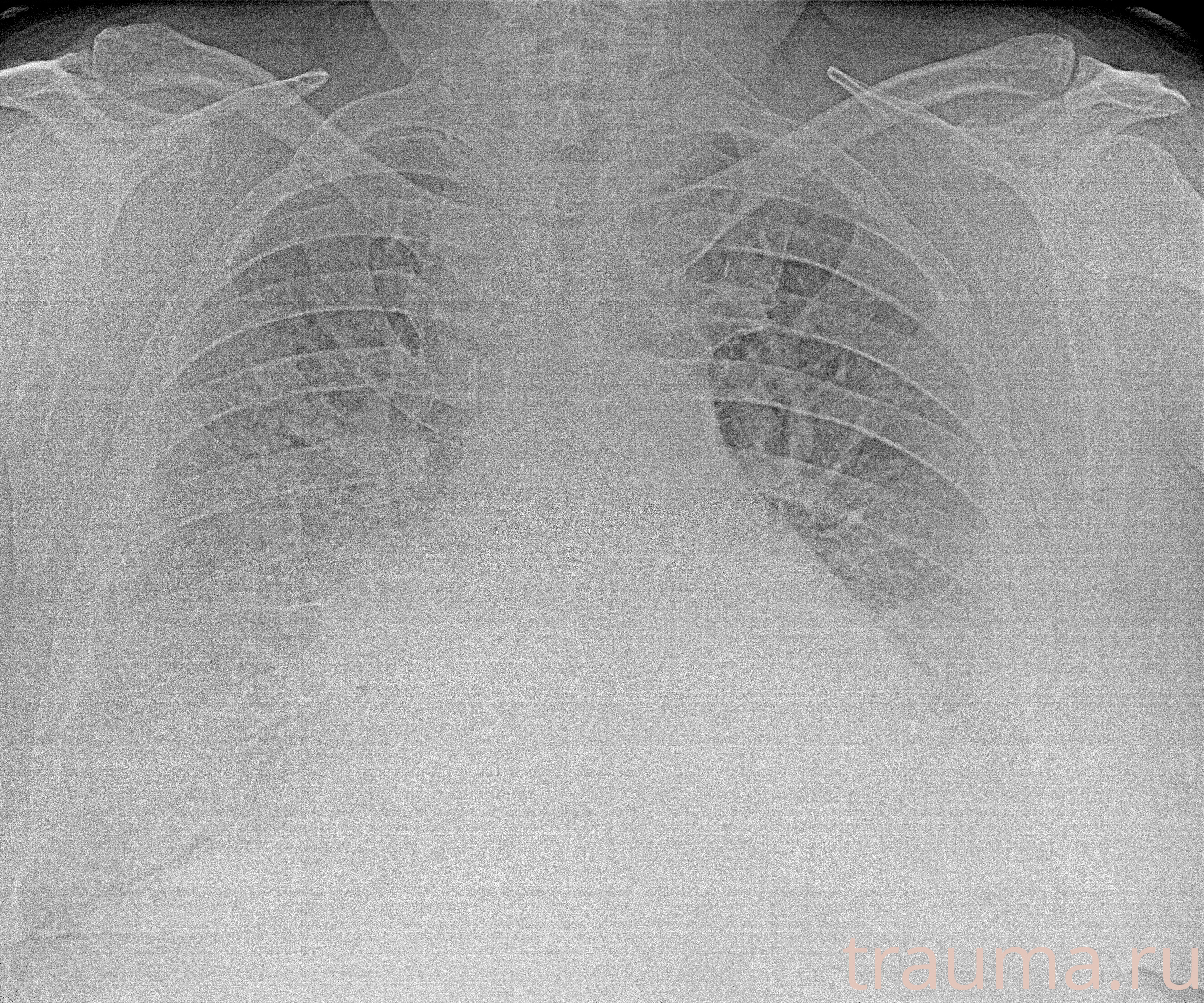 Рентген на дому: по вашему адресу приезжает врач-рентгенолог, травматолог-ортопед с мобильным рентгеновским аппаратом, проводит диагностику травмы или заболевания, делает необходимые рентгенограммы, дает рекомендации по дальнейшему лечению. Получить качественные снимки в домашних условиях возможно благодаря уникальной методике, разработанной МосРентген Центром для института  Склифосовского