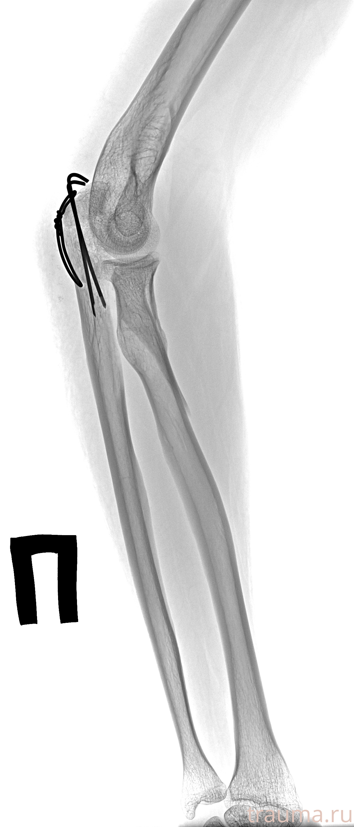 Рентген на дому: по вашему адресу приезжает врач-рентгенолог, травматолог-ортопед с мобильным рентгеновским аппаратом, проводит диагностику травмы или заболевания, делает необходимые рентгенограммы, дает рекомендации по дальнейшему лечению. Получить качественные снимки в домашних условиях возможно благодаря уникальной методике, разработанной МосРентген Центром для института  Склифосовского