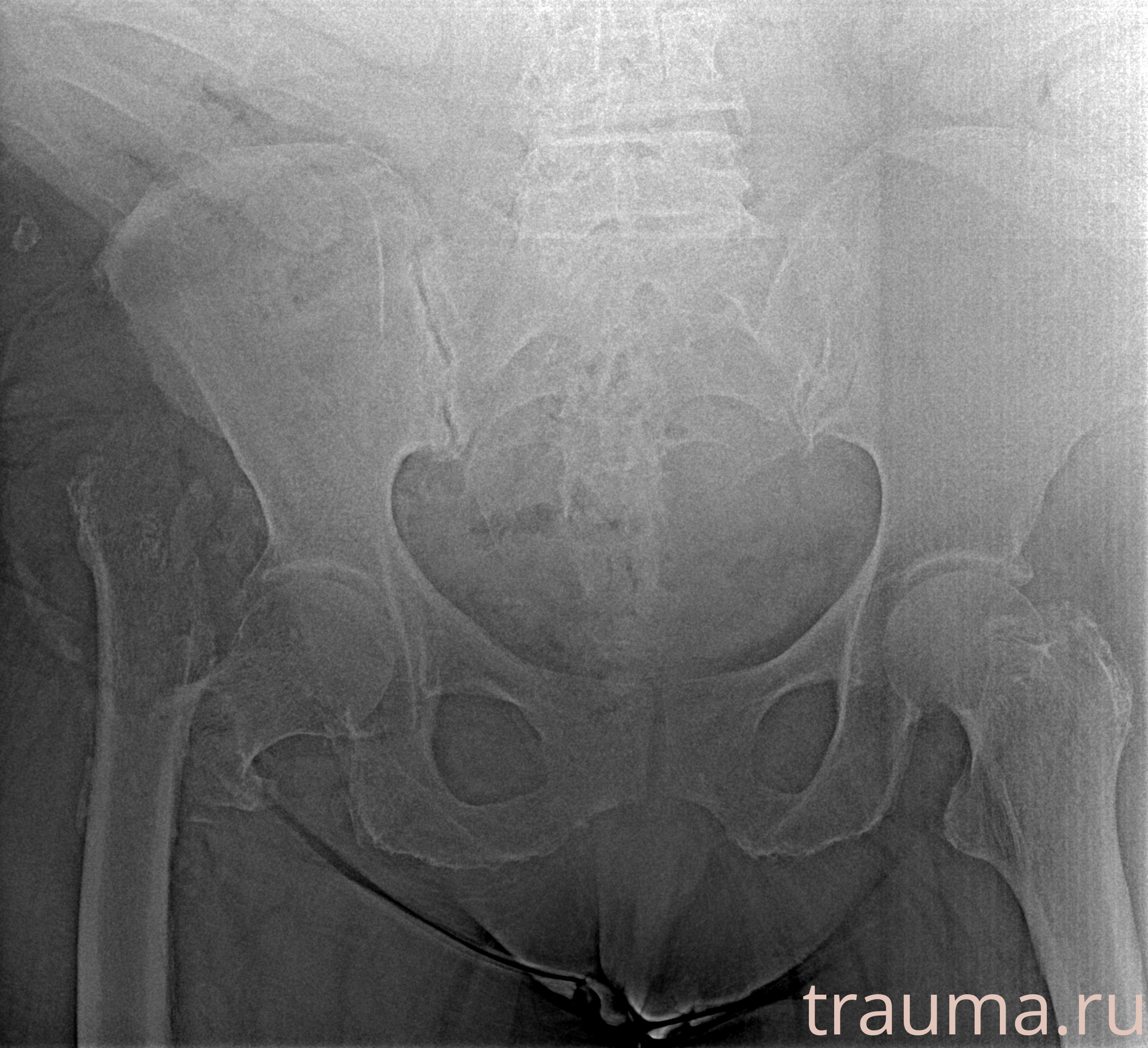 Рентген на дому: по вашему адресу приезжает врач-рентгенолог, травматолог-ортопед с мобильным рентгеновским аппаратом, проводит диагностику травмы или заболевания, делает необходимые рентгенограммы, дает рекомендации по дальнейшему лечению. Получить качественные снимки в домашних условиях возможно благодаря уникальной методике, разработанной МосРентген Центром для института  Склифосовского