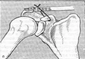 Миграция спицы Киршнера в позвоночный канал после восстановления акромиально-ключичного сочленения (клинический случай)