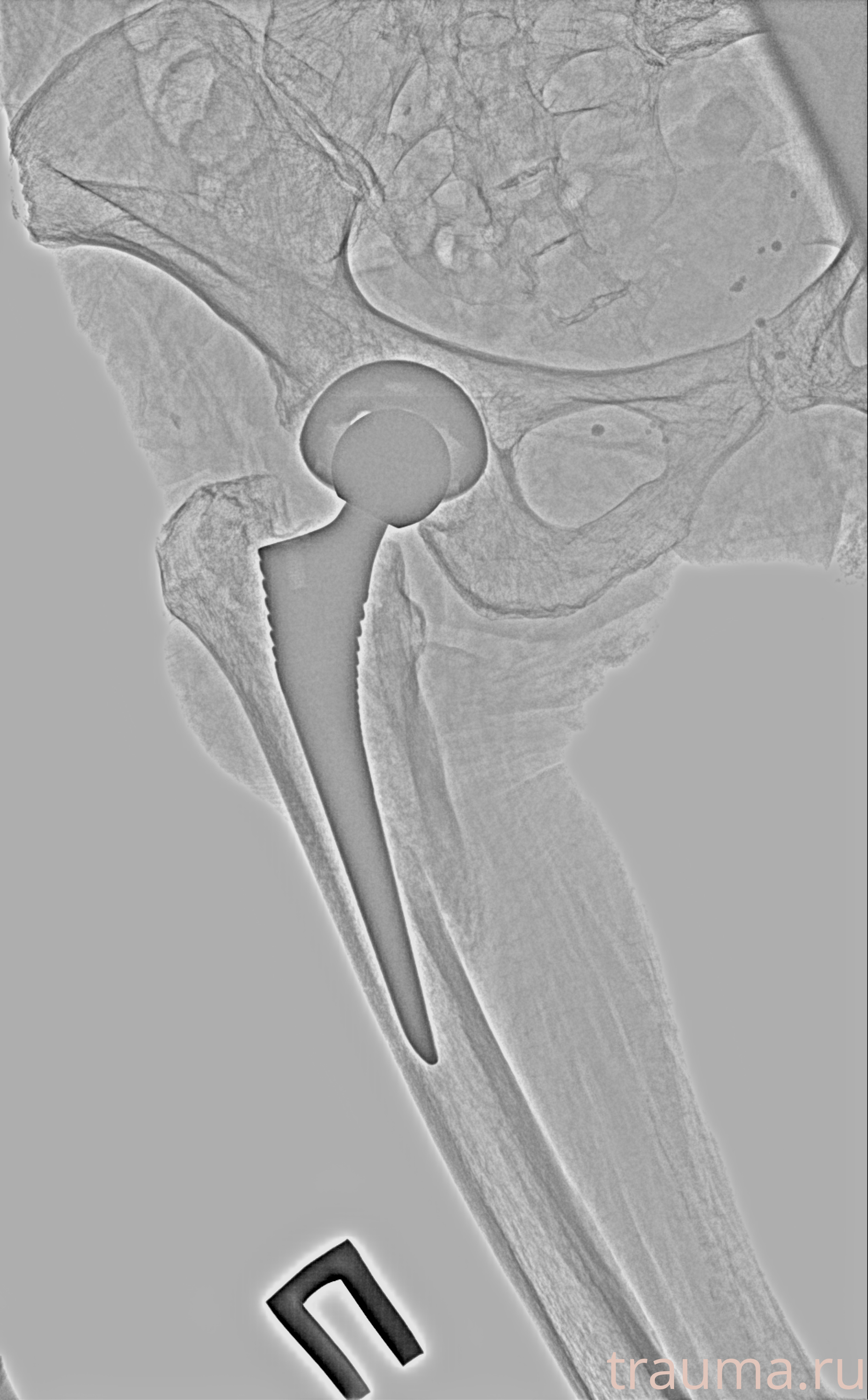 Рентген на дому: по вашему адресу приезжает врач-рентгенолог, травматолог-ортопед с мобильным рентгеновским аппаратом, проводит диагностику травмы или заболевания, делает необходимые рентгенограммы, дает рекомендации по дальнейшему лечению. Получить качественные снимки в домашних условиях возможно благодаря уникальной методике, разработанной МосРентген Центром для института  Склифосовского