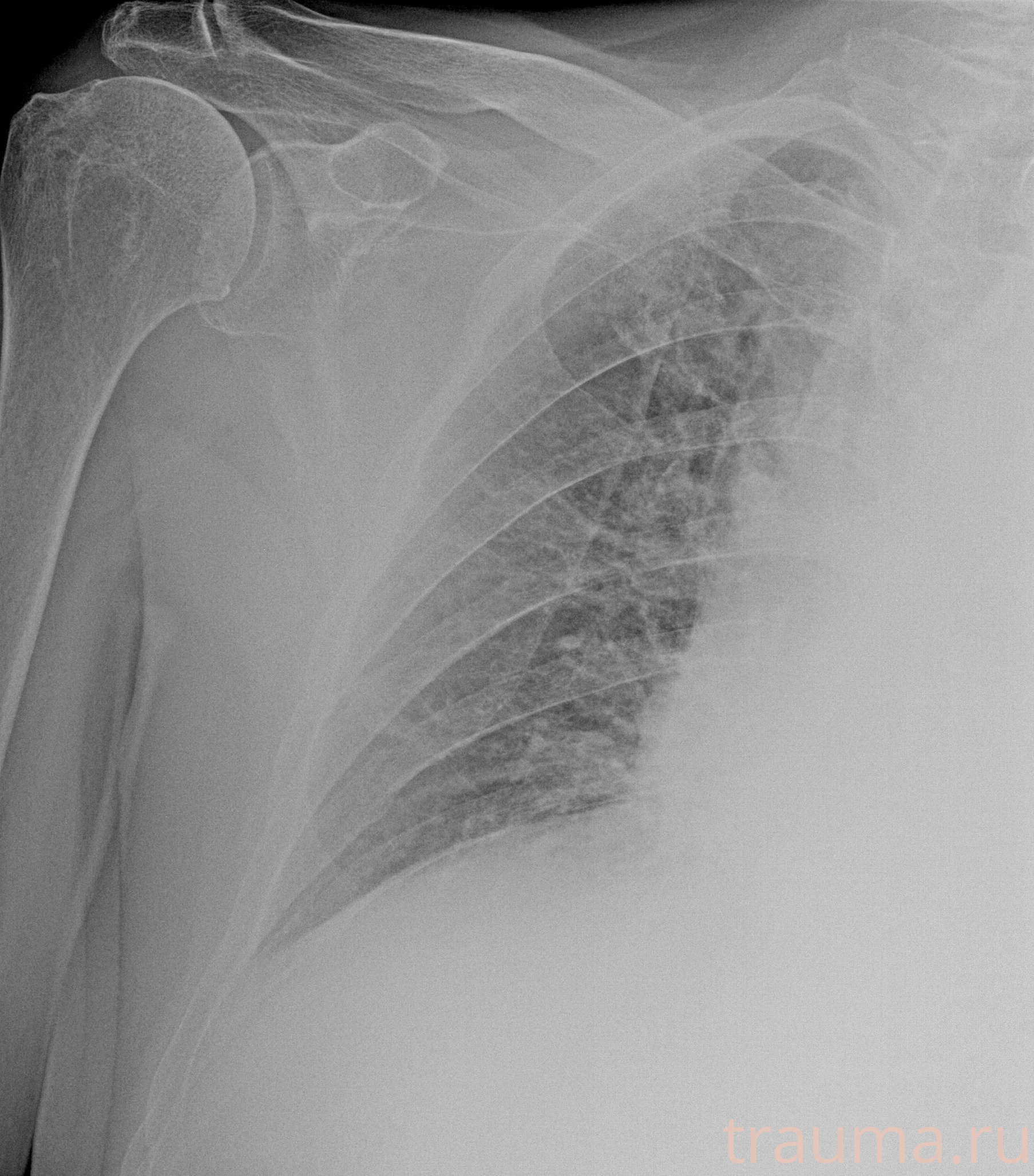 Рентген на дому: по вашему адресу приезжает врач-рентгенолог, травматолог-ортопед с мобильным рентгеновским аппаратом, проводит диагностику травмы или заболевания, делает необходимые рентгенограммы, дает рекомендации по дальнейшему лечению. Получить качественные снимки в домашних условиях возможно благодаря уникальной методике, разработанной МосРентген Центром для института  Склифосовского