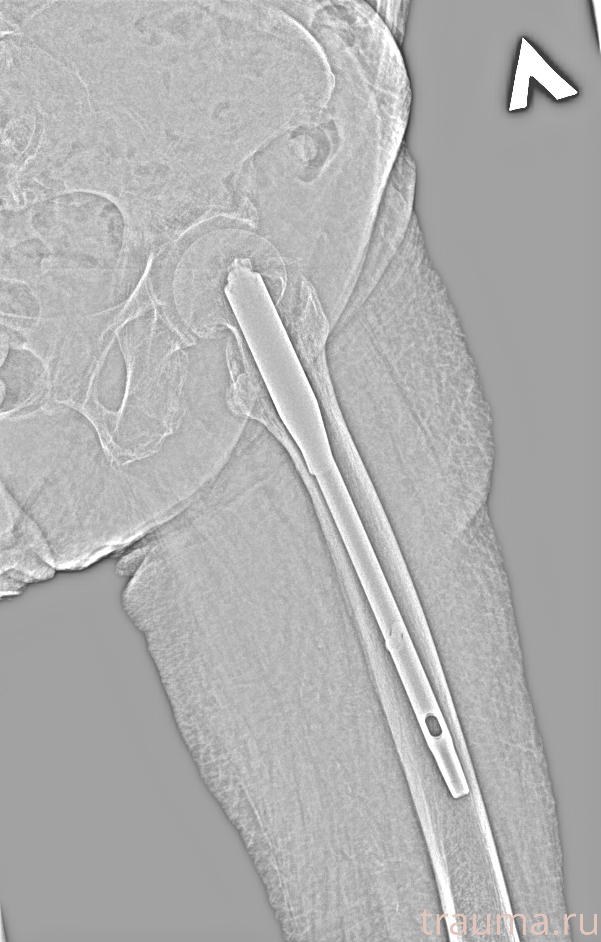 Рентген на дому: по вашему адресу приезжает врач-рентгенолог, травматолог-ортопед с мобильным рентгеновским аппаратом, проводит диагностику травмы или заболевания, делает необходимые рентгенограммы, дает рекомендации по дальнейшему лечению. Получить качественные снимки в домашних условиях возможно благодаря уникальной методике, разработанной МосРентген Центром для института  Склифосовского
