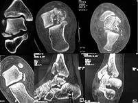 Лечение переломов таранной кости