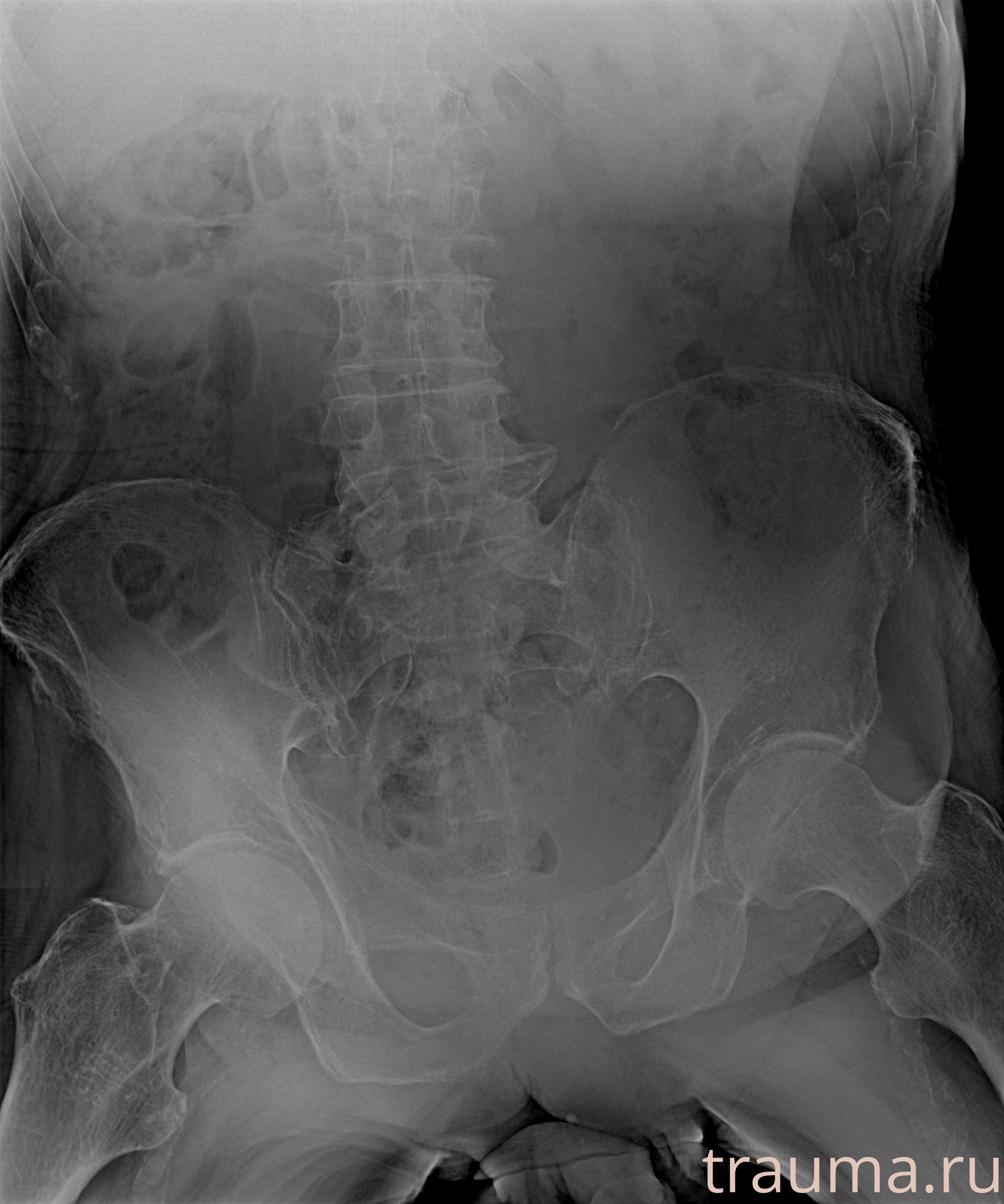 Рентген на дому: по вашему адресу приезжает врач-рентгенолог, травматолог-ортопед с мобильным рентгеновским аппаратом, проводит диагностику травмы или заболевания, делает необходимые рентгенограммы, дает рекомендации по дальнейшему лечению. Получить качественные снимки в домашних условиях возможно благодаря уникальной методике, разработанной МосРентген Центром для института  Склифосовского