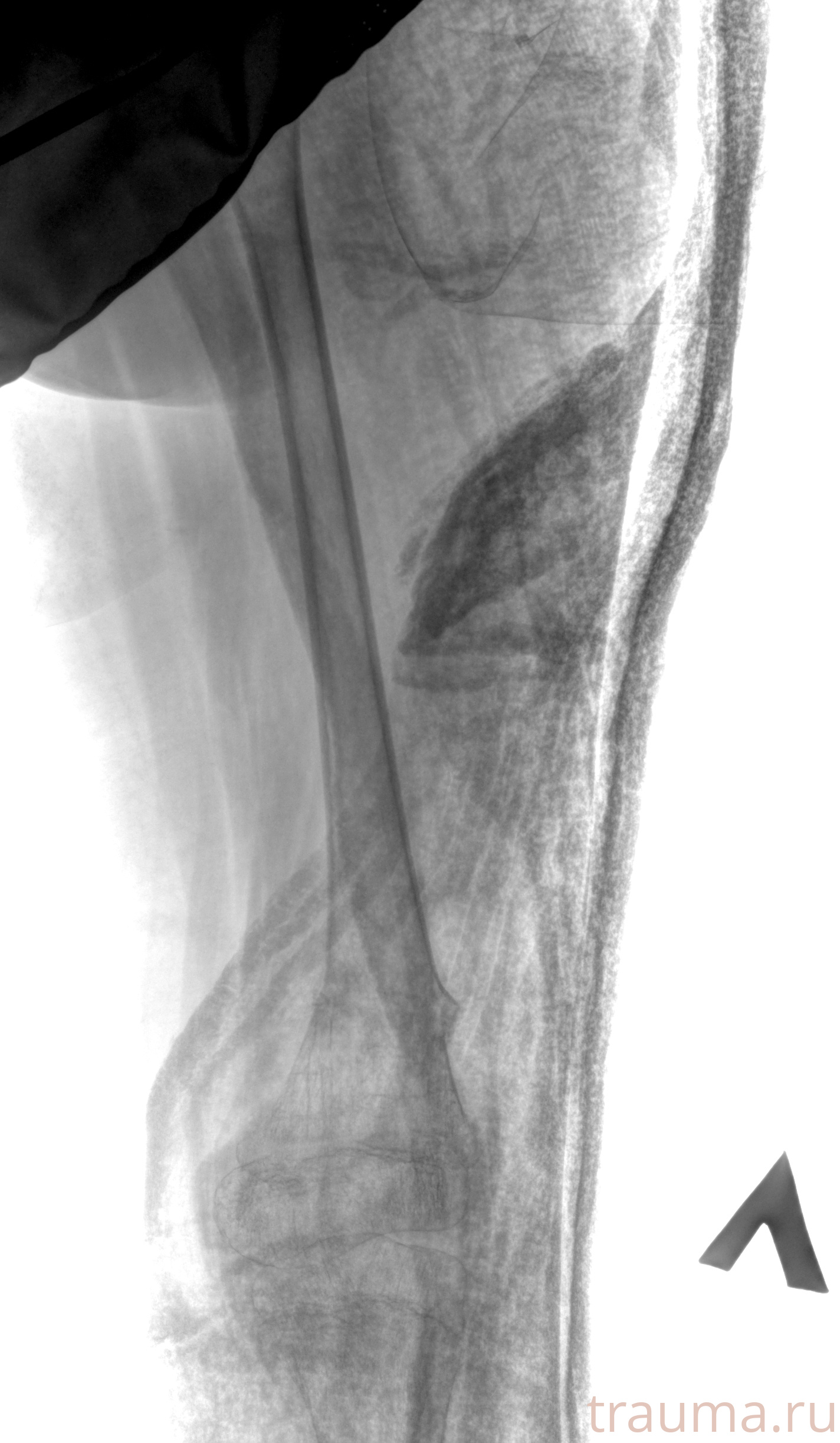 Рентген на дому: по вашему адресу приезжает врач-рентгенолог, травматолог-ортопед с мобильным рентгеновским аппаратом, проводит диагностику травмы или заболевания, делает необходимые рентгенограммы, дает рекомендации по дальнейшему лечению. Получить качественные снимки в домашних условиях возможно благодаря уникальной методике, разработанной МосРентген Центром для института  Склифосовского