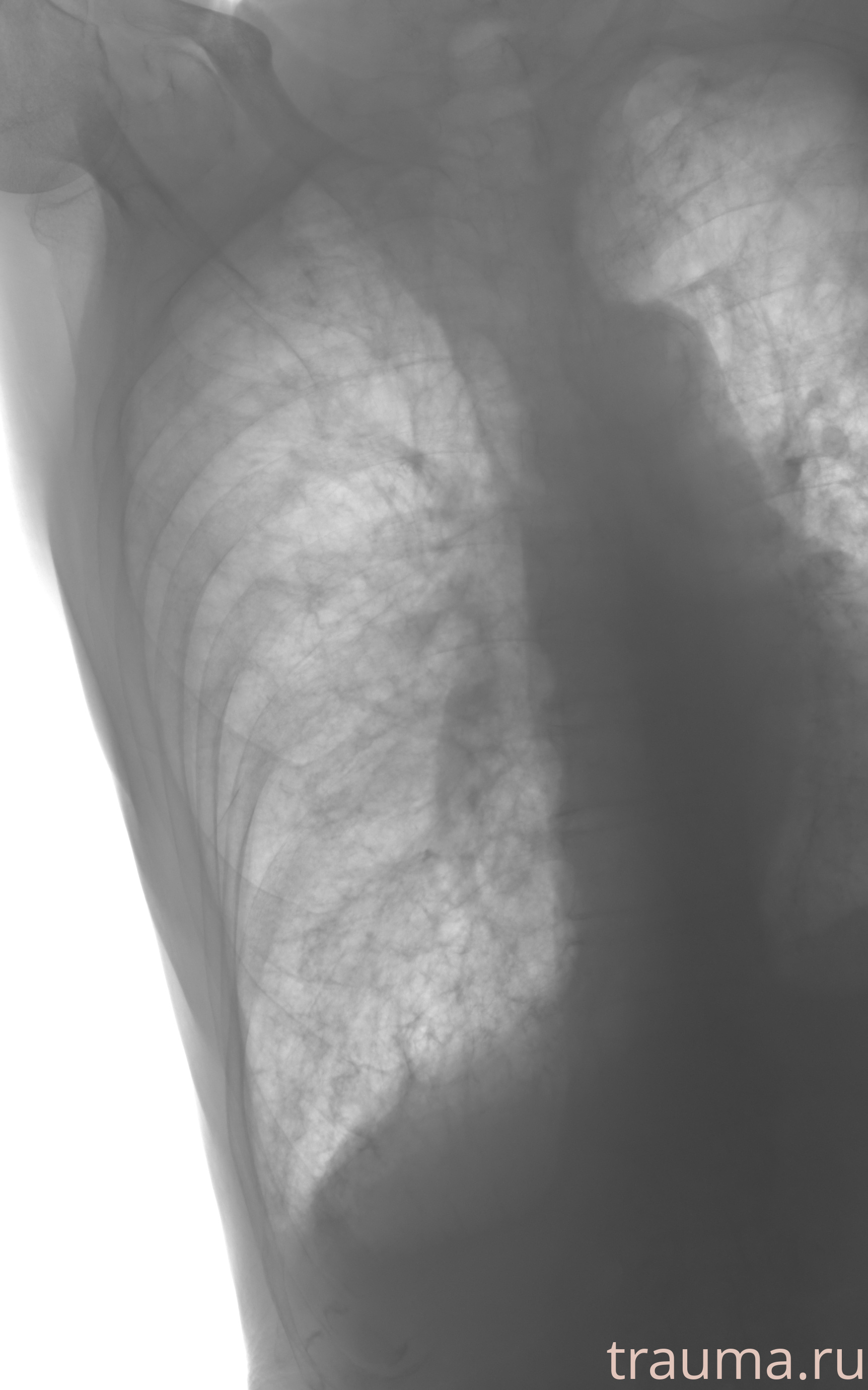 Рентген на дому: по вашему адресу приезжает врач-рентгенолог, травматолог-ортопед с мобильным рентгеновским аппаратом, проводит диагностику травмы или заболевания, делает необходимые рентгенограммы, дает рекомендации по дальнейшему лечению. Получить качественные снимки в домашних условиях возможно благодаря уникальной методике, разработанной МосРентген Центром для института  Склифосовского