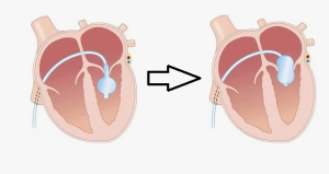 Роль рентгенологической навигации при трансапикальной имплантации митральных неохорд при значимой митральной регургитации на работающем сердце

