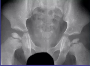 Патология тазобедренных суставов у пациентов с rpl13-ассоциированной спондилоэпиметафизарной дисплазией: результат анализа серии случаев и принципы дифференциальной диагностики с болезнью Легга — Кальве — Пертеса