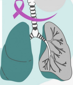 Проблемы и достижения в лечении рака легких   Проблемы и достижения в лечении рака легких