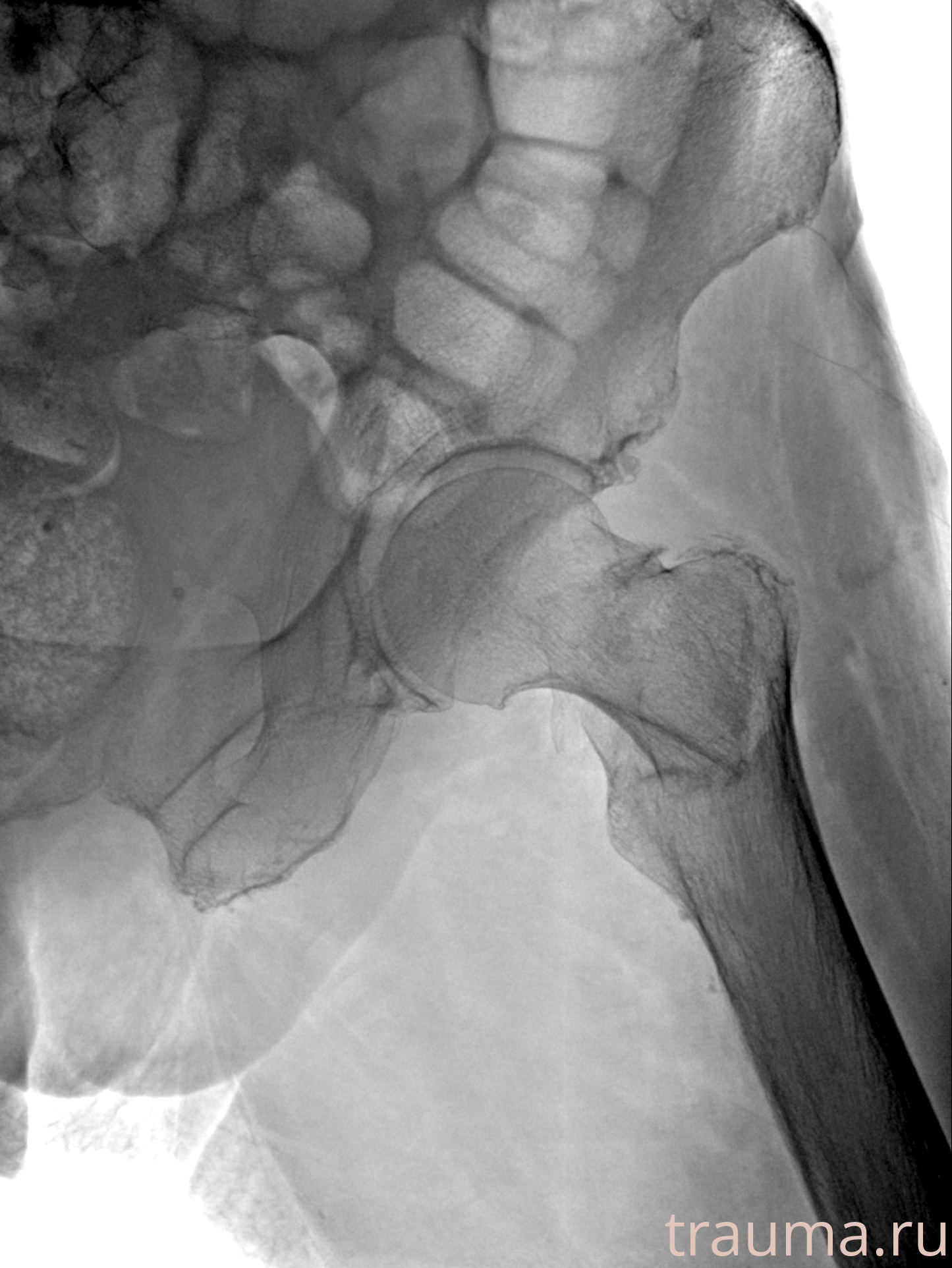 Рентген на дому: по вашему адресу приезжает врач-рентгенолог, травматолог-ортопед с мобильным рентгеновским аппаратом, проводит диагностику травмы или заболевания, делает необходимые рентгенограммы, дает рекомендации по дальнейшему лечению. Получить качественные снимки в домашних условиях возможно благодаря уникальной методике, разработанной МосРентген Центром для института  Склифосовского