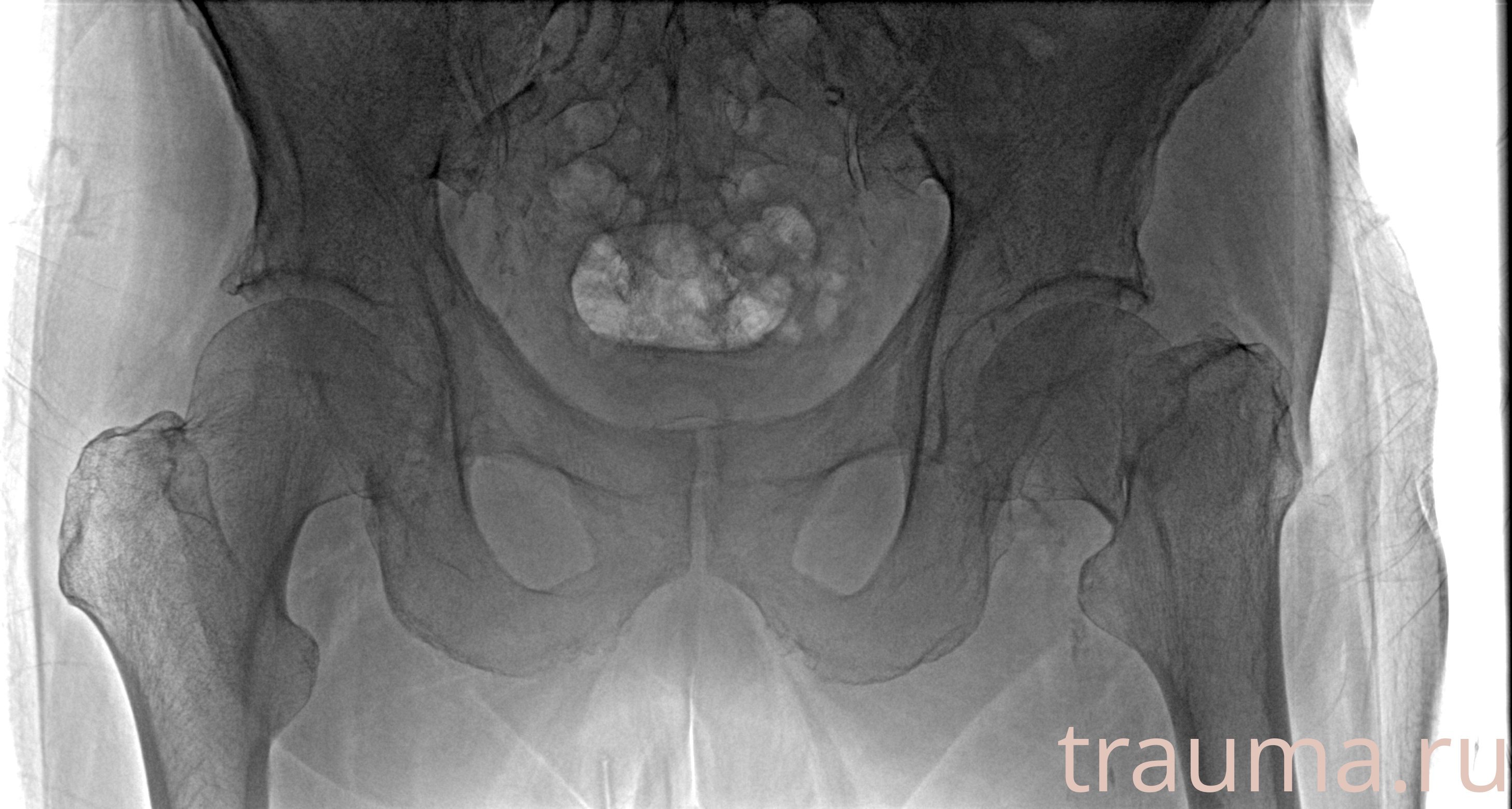 Рентген на дому: по вашему адресу приезжает врач-рентгенолог, травматолог-ортопед с мобильным рентгеновским аппаратом, проводит диагностику травмы или заболевания, делает необходимые рентгенограммы, дает рекомендации по дальнейшему лечению. Получить качественные снимки в домашних условиях возможно благодаря уникальной методике, разработанной МосРентген Центром для института  Склифосовского
