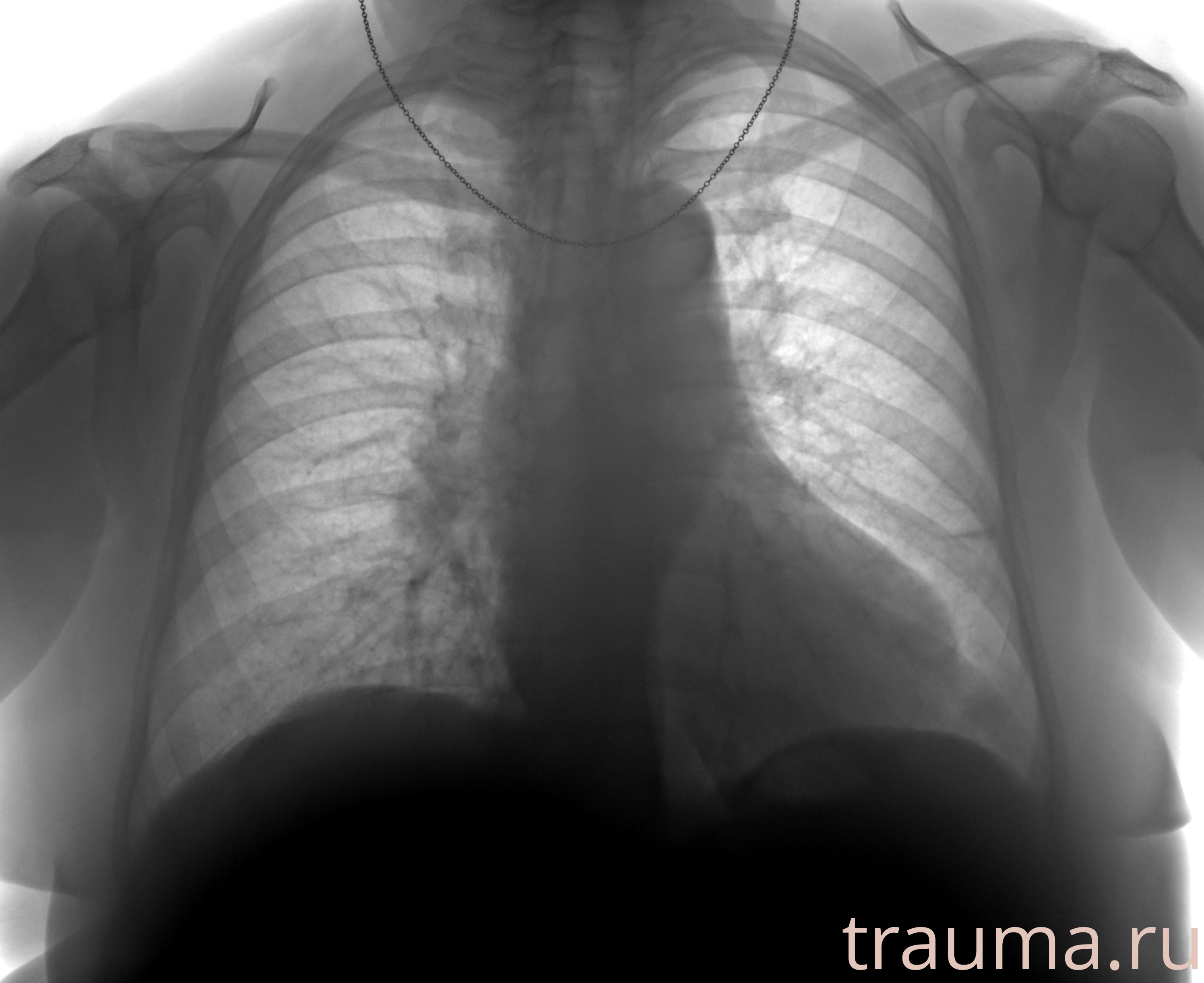 Рентген на дому: по вашему адресу приезжает врач-рентгенолог, травматолог-ортопед с мобильным рентгеновским аппаратом, проводит диагностику травмы или заболевания, делает необходимые рентгенограммы, дает рекомендации по дальнейшему лечению. Получить качественные снимки в домашних условиях возможно благодаря уникальной методике, разработанной МосРентген Центром для института  Склифосовского