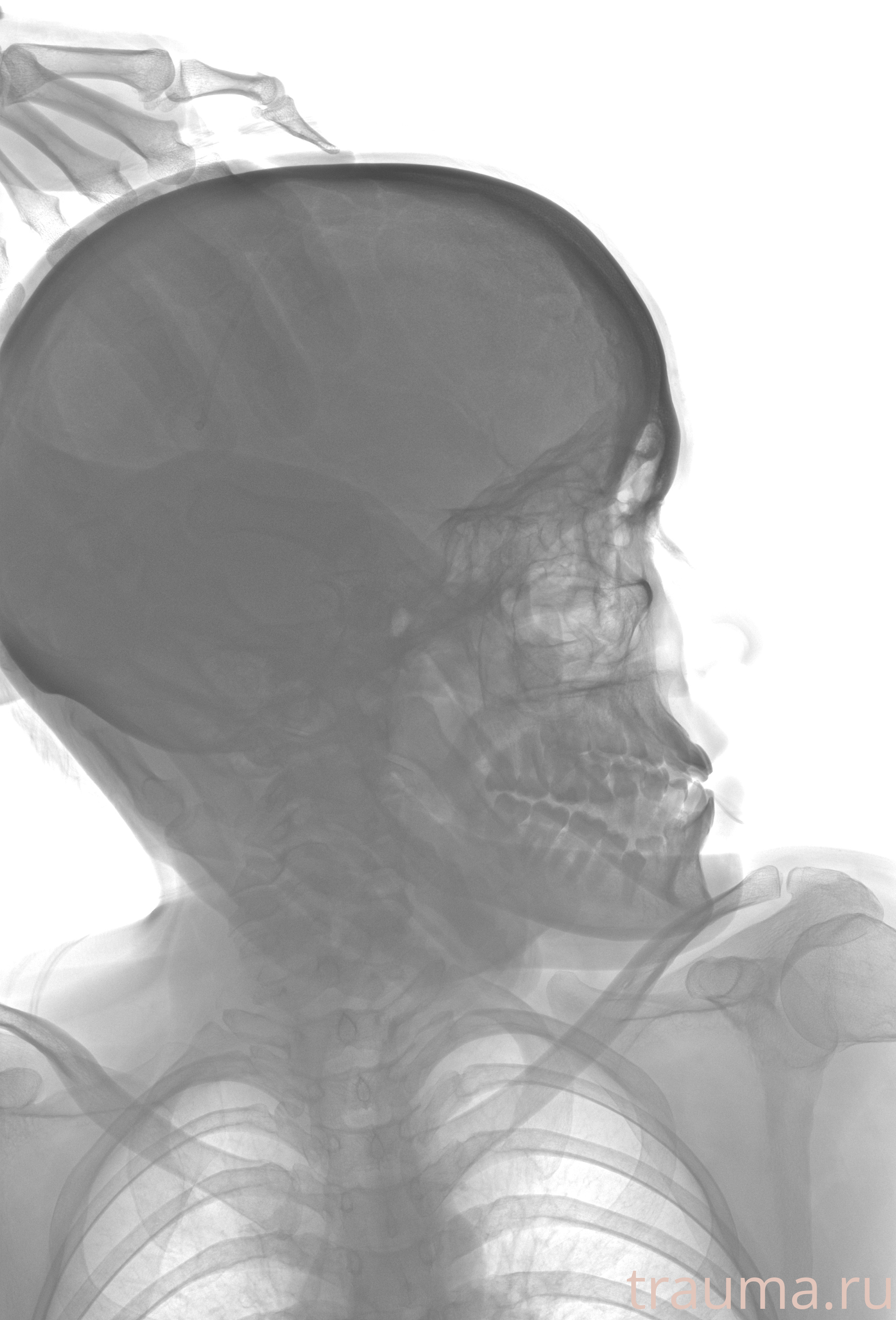 Рентген на дому: по вашему адресу приезжает врач-рентгенолог, травматолог-ортопед с мобильным рентгеновским аппаратом, проводит диагностику травмы или заболевания, делает необходимые рентгенограммы, дает рекомендации по дальнейшему лечению. Получить качественные снимки в домашних условиях возможно благодаря уникальной методике, разработанной МосРентген Центром для института  Склифосовского