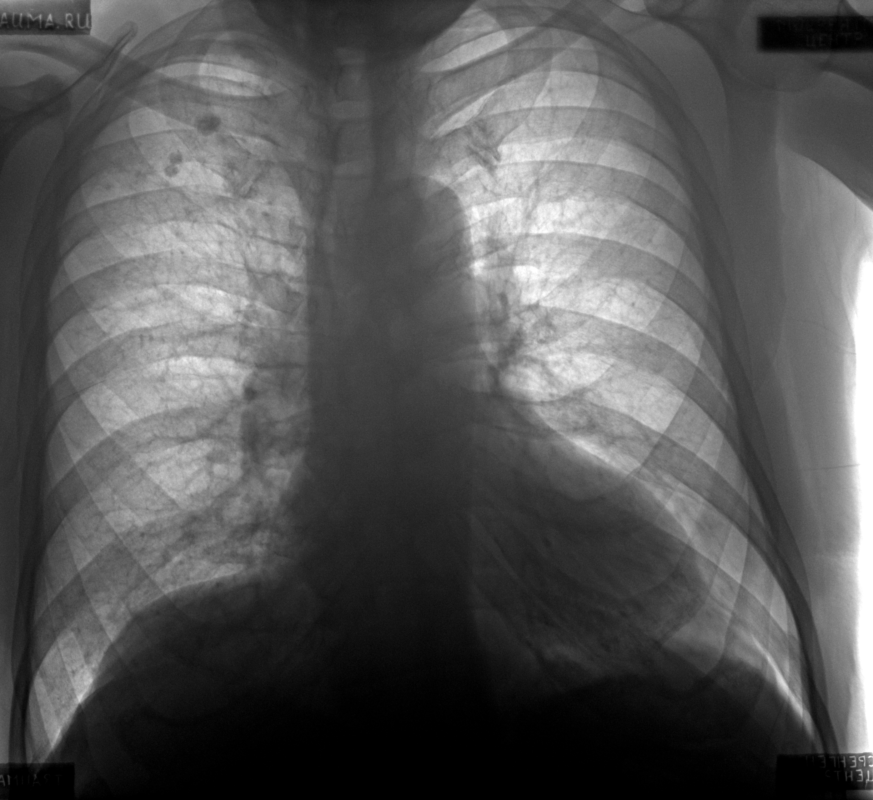 Полисегментарная пневмония рентген