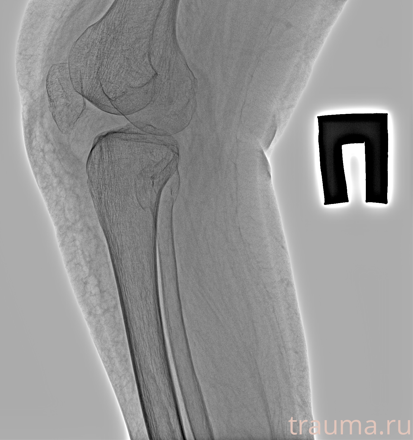 Рентген на дому: по вашему адресу приезжает врач-рентгенолог, травматолог-ортопед с мобильным рентгеновским аппаратом, проводит диагностику травмы или заболевания, делает необходимые рентгенограммы, дает рекомендации по дальнейшему лечению. Получить качественные снимки в домашних условиях возможно благодаря уникальной методике, разработанной МосРентген Центром для института  Склифосовского