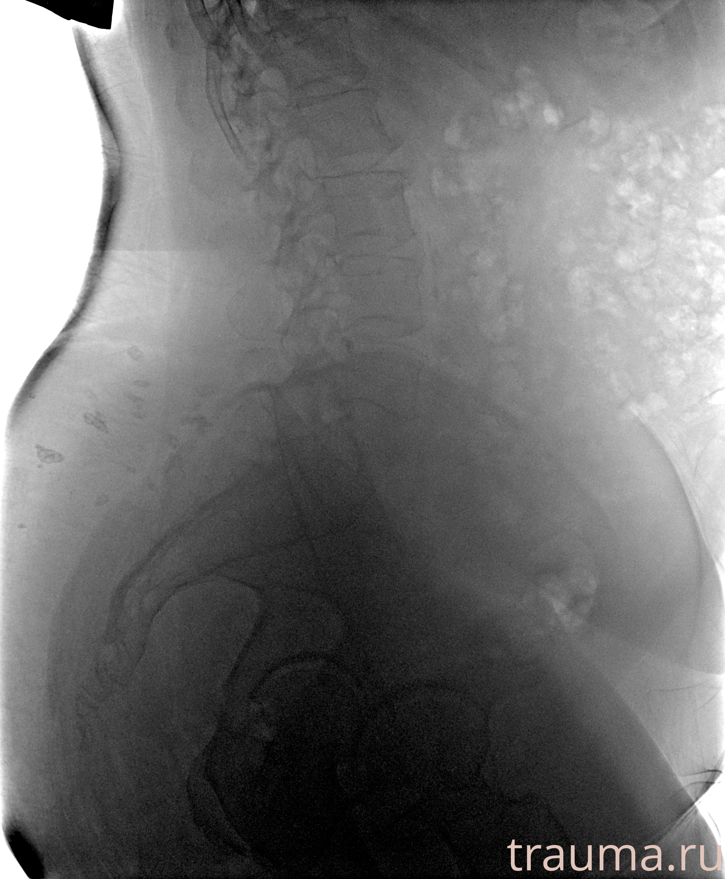 Рентген на дому: по вашему адресу приезжает врач-рентгенолог, травматолог-ортопед с мобильным рентгеновским аппаратом, проводит диагностику травмы или заболевания, делает необходимые рентгенограммы, дает рекомендации по дальнейшему лечению. Получить качественные снимки в домашних условиях возможно благодаря уникальной методике, разработанной МосРентген Центром для института  Склифосовского