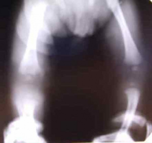 Магнитно-резонансная томография остеомиелита у  детей 
