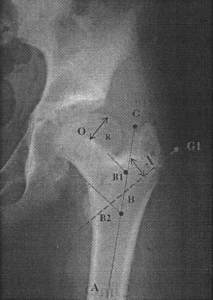 Оценка нарушений вертикального баланса тела детей с односторонним поражением проксимального отдела бедренной кости
