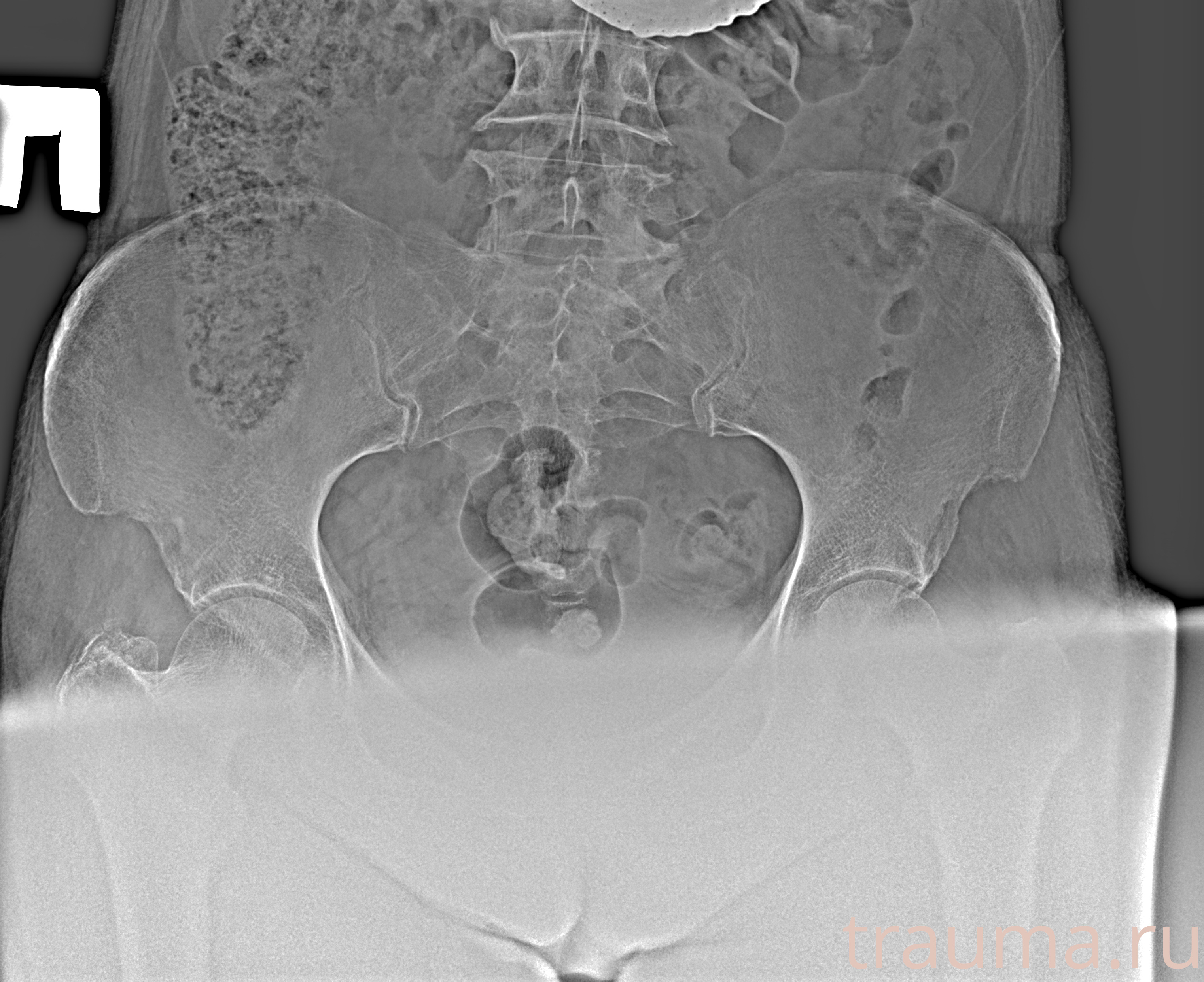 Рентген на дому: по вашему адресу приезжает врач-рентгенолог, травматолог-ортопед с мобильным рентгеновским аппаратом, проводит диагностику травмы или заболевания, делает необходимые рентгенограммы, дает рекомендации по дальнейшему лечению. Получить качественные снимки в домашних условиях возможно благодаря уникальной методике, разработанной МосРентген Центром для института  Склифосовского