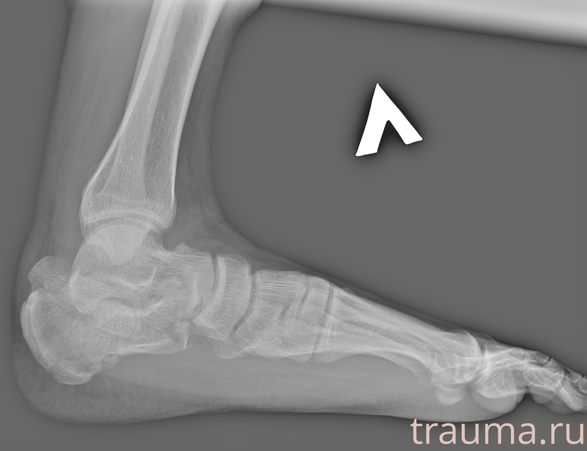 Рентген на дому: по вашему адресу приезжает врач-рентгенолог, травматолог-ортопед с мобильным рентгеновским аппаратом, проводит диагностику травмы или заболевания, делает необходимые рентгенограммы, дает рекомендации по дальнейшему лечению. Получить качественные снимки в домашних условиях возможно благодаря уникальной методике, разработанной МосРентген Центром для института  Склифосовского