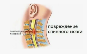 Особенности повреждений позвоночника и спинного мозга
Особенности повреждений позвоночника и спинного мозга