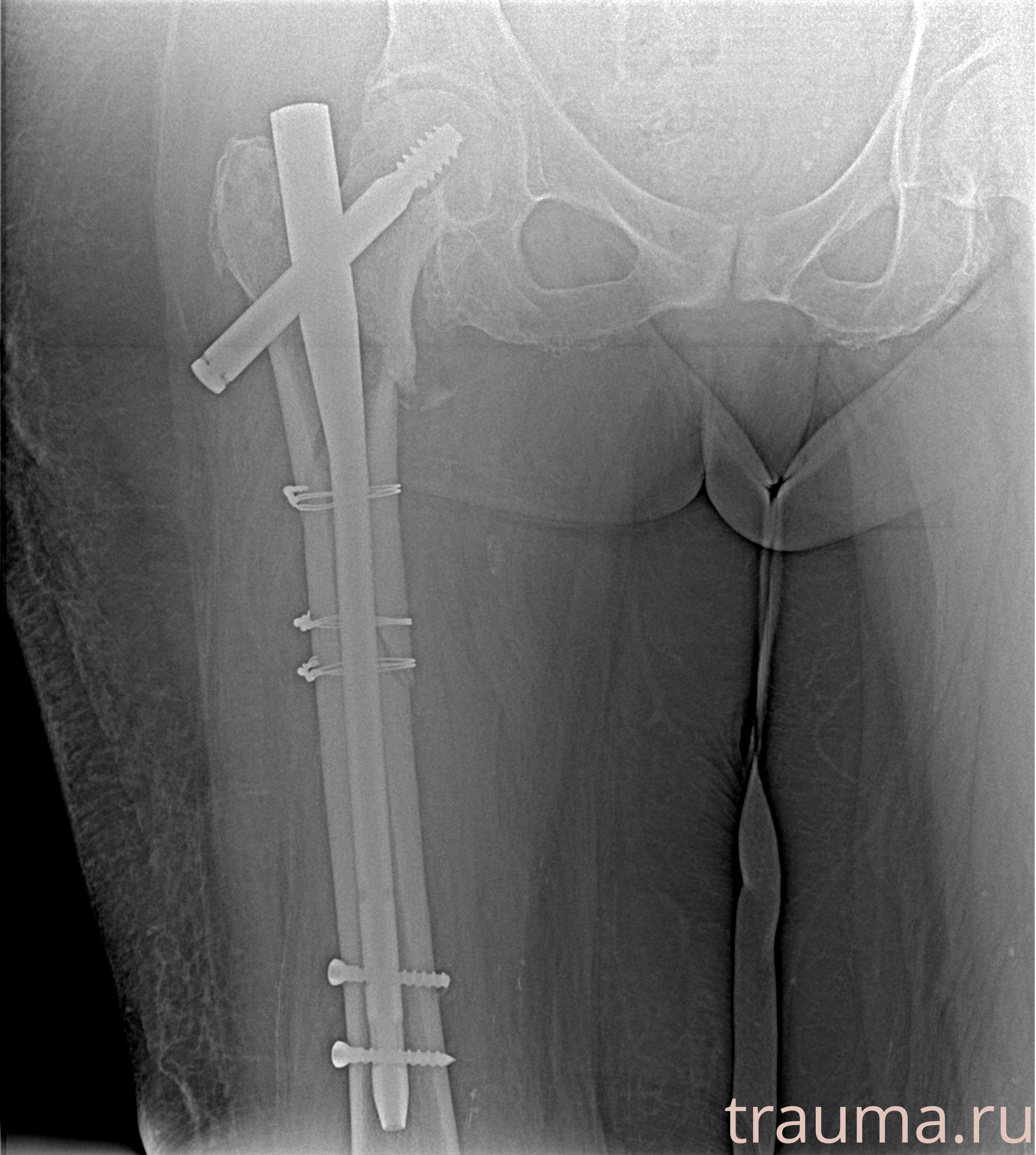 Рентген на дому: по вашему адресу приезжает врач-рентгенолог, травматолог-ортопед с мобильным рентгеновским аппаратом, проводит диагностику травмы или заболевания, делает необходимые рентгенограммы, дает рекомендации по дальнейшему лечению. Получить качественные снимки в домашних условиях возможно благодаря уникальной методике, разработанной МосРентген Центром для института  Склифосовского