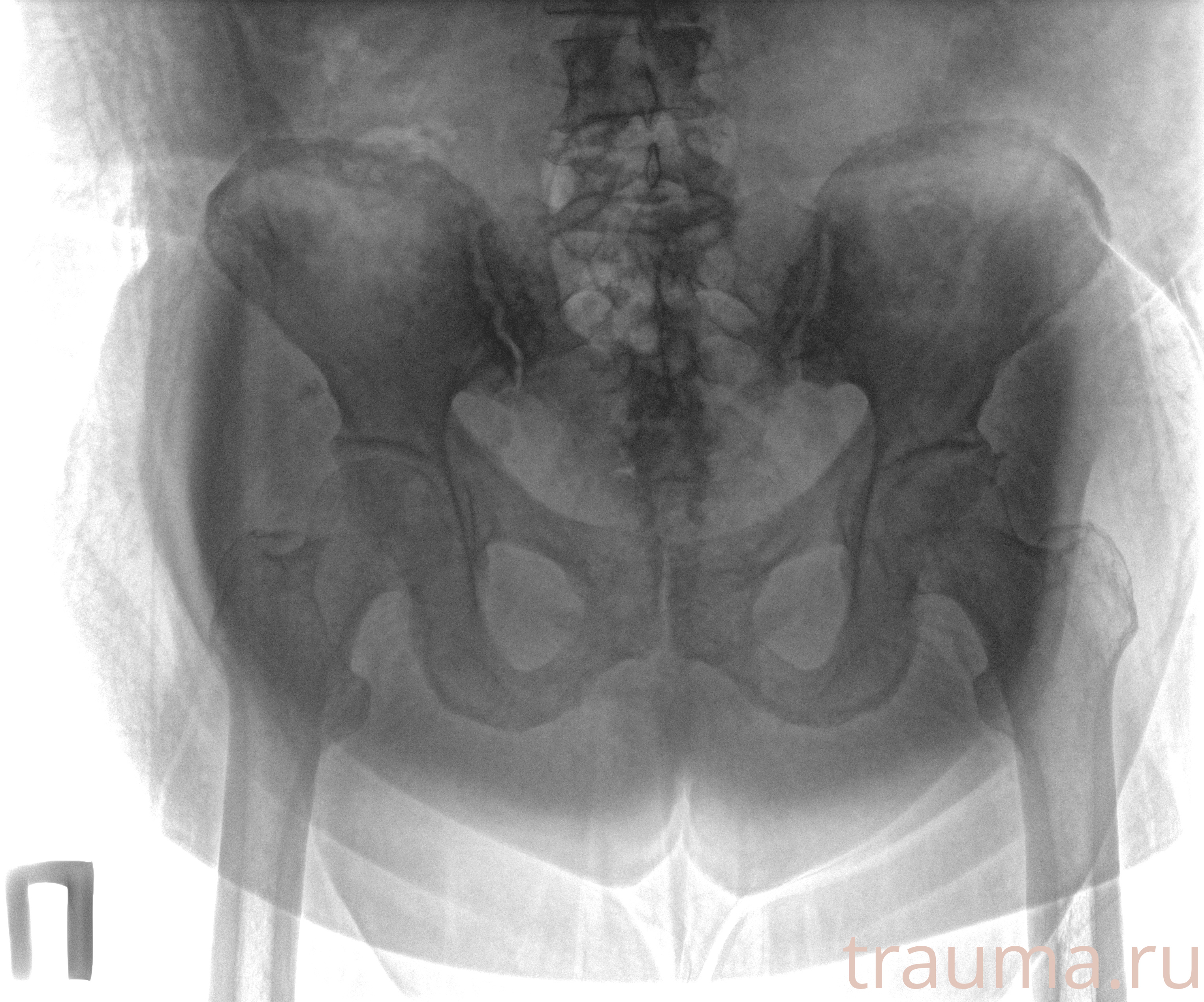 Рентген на дому: по вашему адресу приезжает врач-рентгенолог, травматолог-ортопед с мобильным рентгеновским аппаратом, проводит диагностику травмы или заболевания, делает необходимые рентгенограммы, дает рекомендации по дальнейшему лечению. Получить качественные снимки в домашних условиях возможно благодаря уникальной методике, разработанной МосРентген Центром для института  Склифосовского