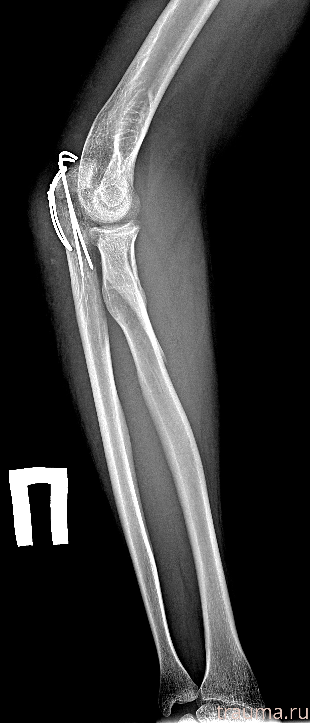 Рентген на дому: по вашему адресу приезжает врач-рентгенолог, травматолог-ортопед с мобильным рентгеновским аппаратом, проводит диагностику травмы или заболевания, делает необходимые рентгенограммы, дает рекомендации по дальнейшему лечению. Получить качественные снимки в домашних условиях возможно благодаря уникальной методике, разработанной МосРентген Центром для института  Склифосовского